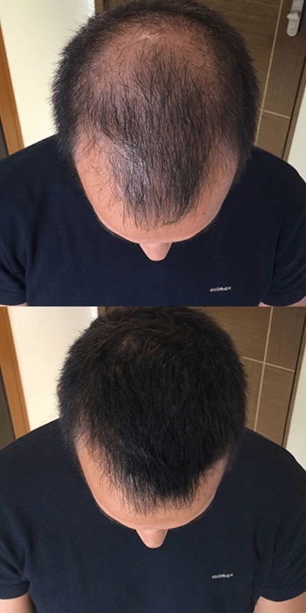 Before and after photos of a patient's crown showing hair regrowth after hair loss treatment at Helalat Clinic