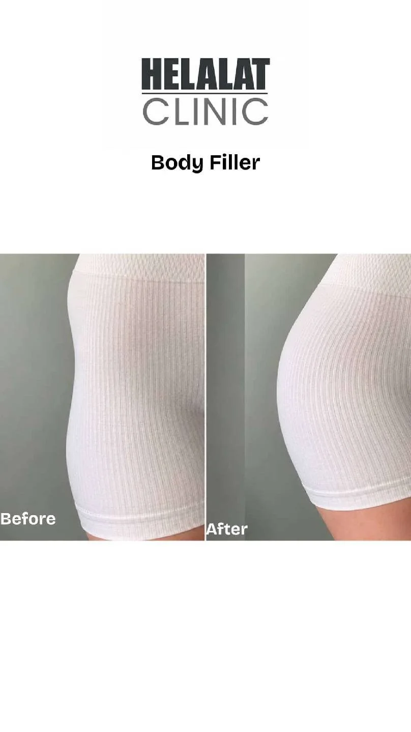 Before and after hip dip filler results at Helalat Clinic in Amman