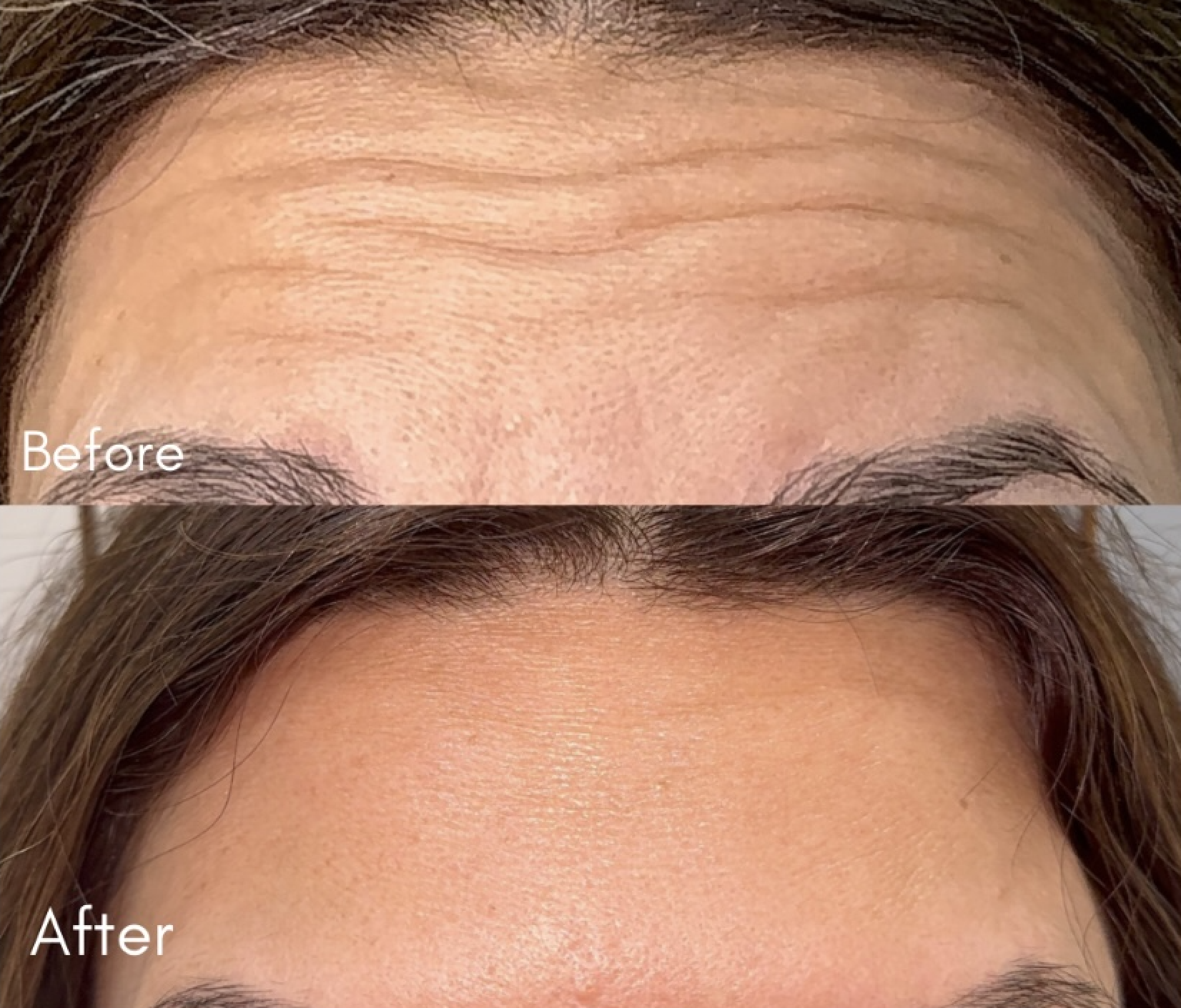 Before and after Botox frown line results at Helalat Clinic in Amman