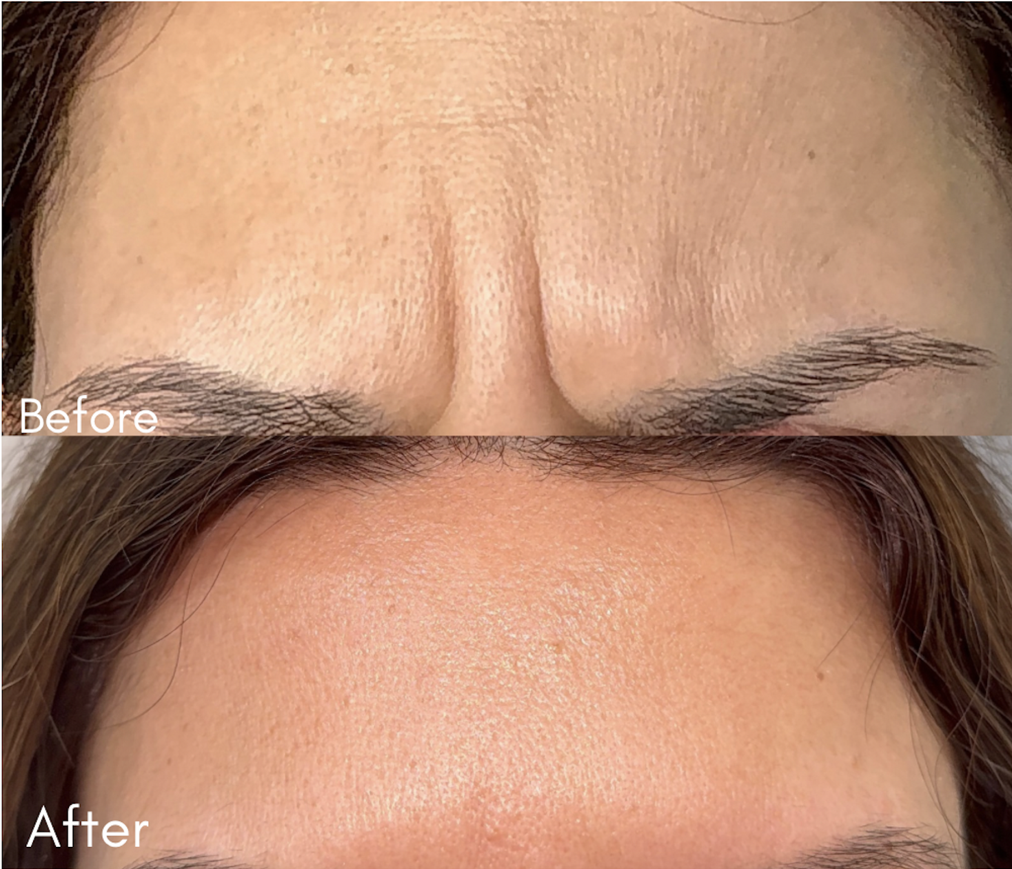 Before and after Botox forehead line results at Helalat Clinic in Amman