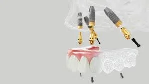 Top 10 Questions Patients Ask | All-on-4® Dental Implants