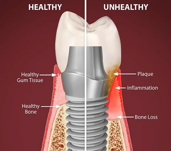 Why The Gum Tissue Around Dental Implants Matters