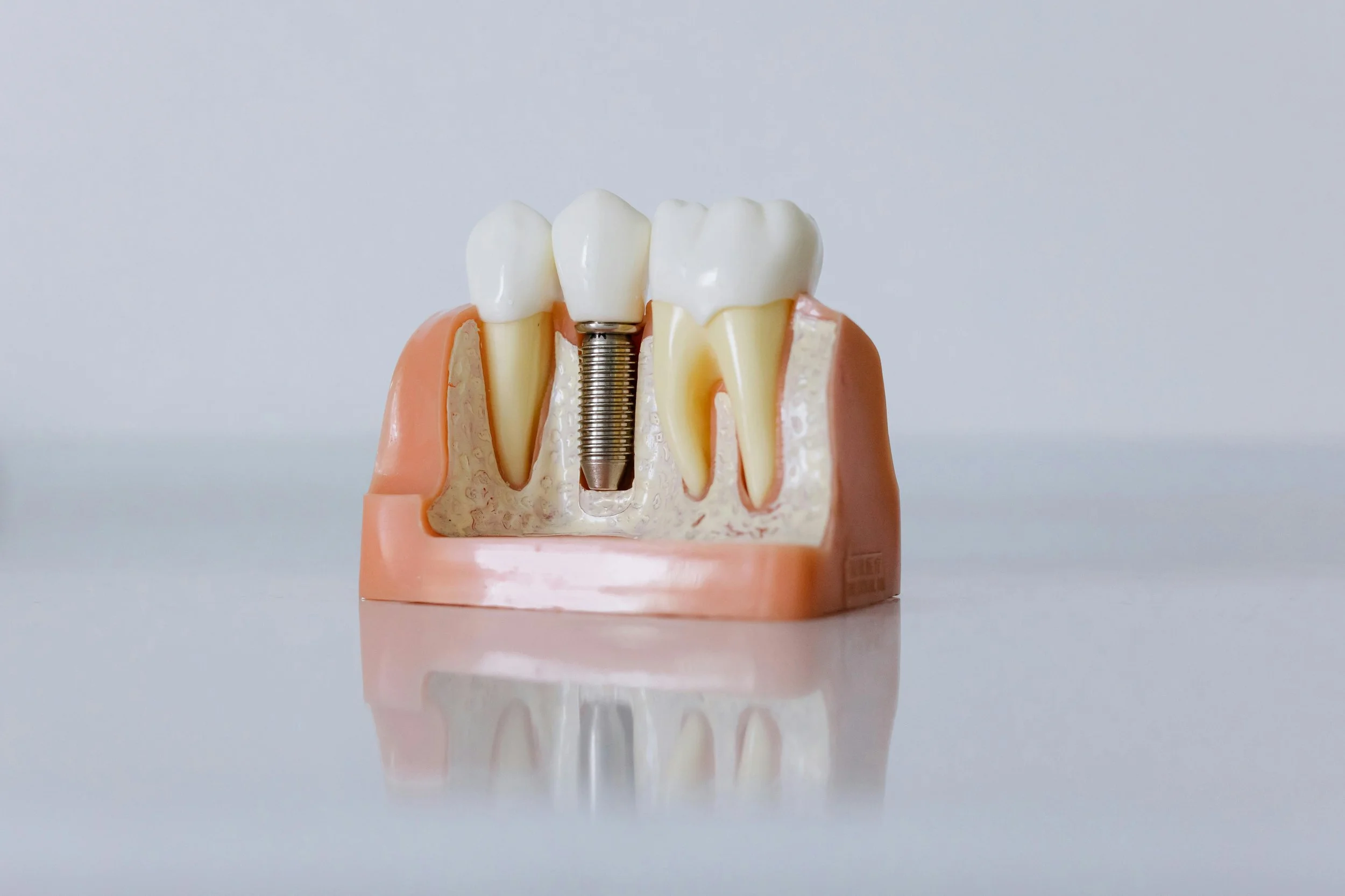 Top All-on-4 Dental Implant Questions