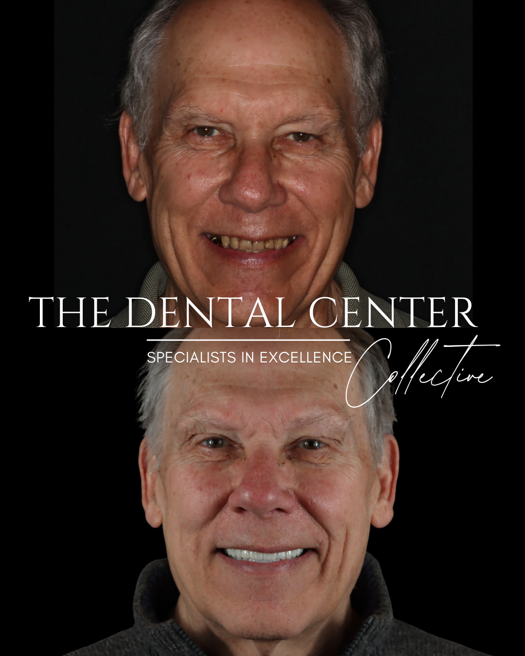 Man with incredible smile transformation with same-day implants to support fixed dentures. 