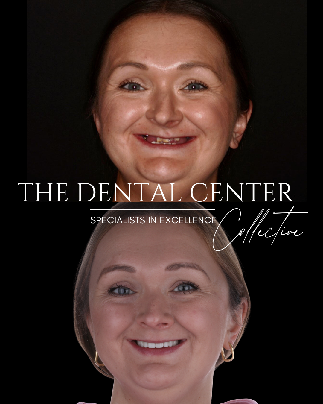 Explore the remarkable before-and-after results of dental implants on a young woman’s smile. This transformation highlights improved dental health, enhanced aesthetics, and renewed self-confidence. Discover how dental implants can change lives with d