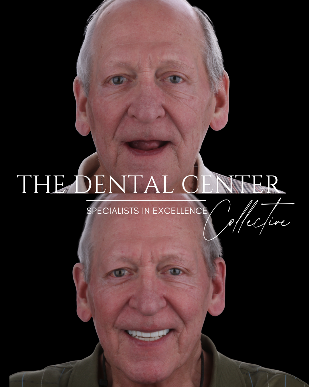 Using the All-on-4 dental implant technique, we replaced the removable denture with a fixed, full-arch implant-supported prosthesis in a single surgical visit. Four strategically placed dental implants were used to securely anchor a new set of teeth,