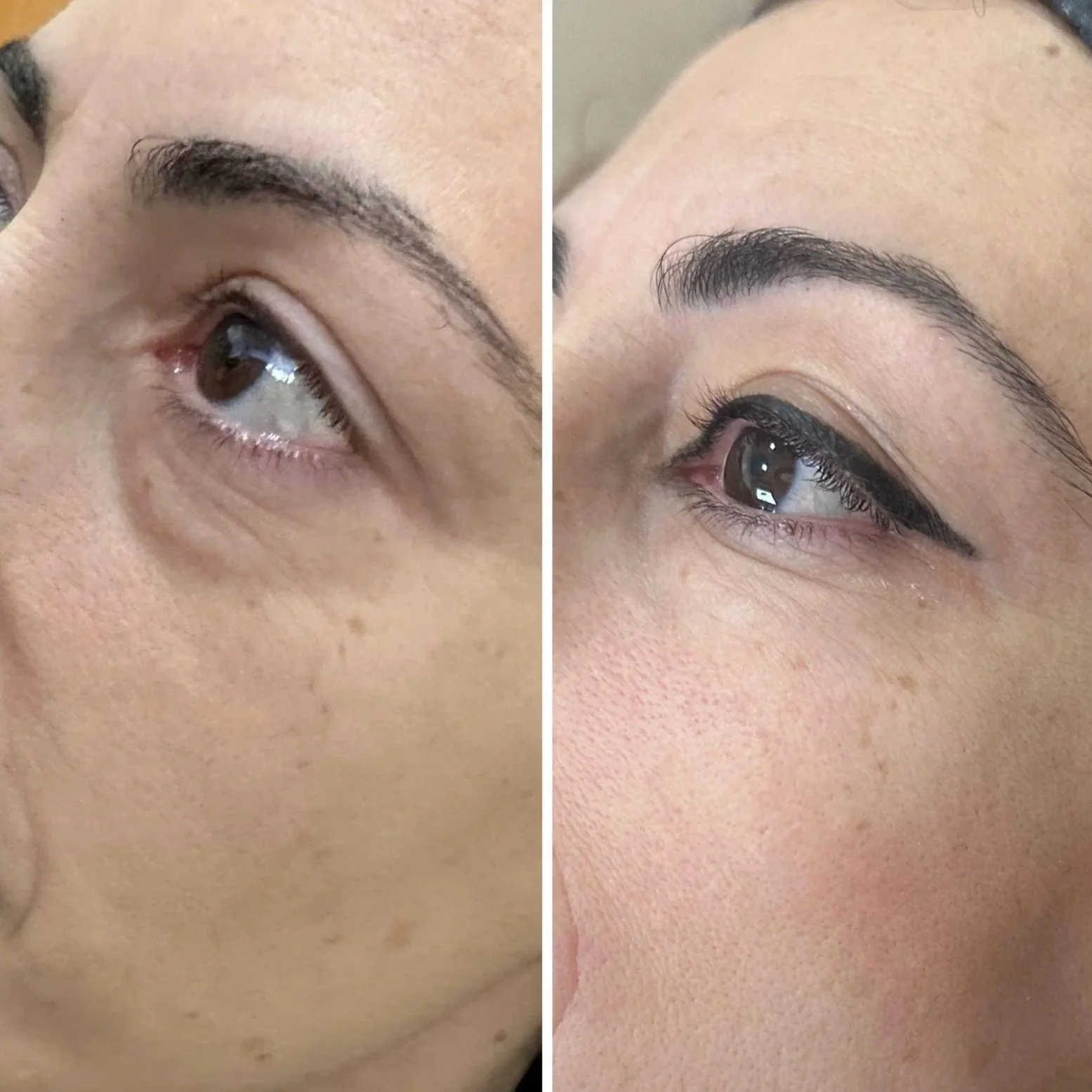 TeslaMed skin rejuvenation treatment at Natura in Kensington