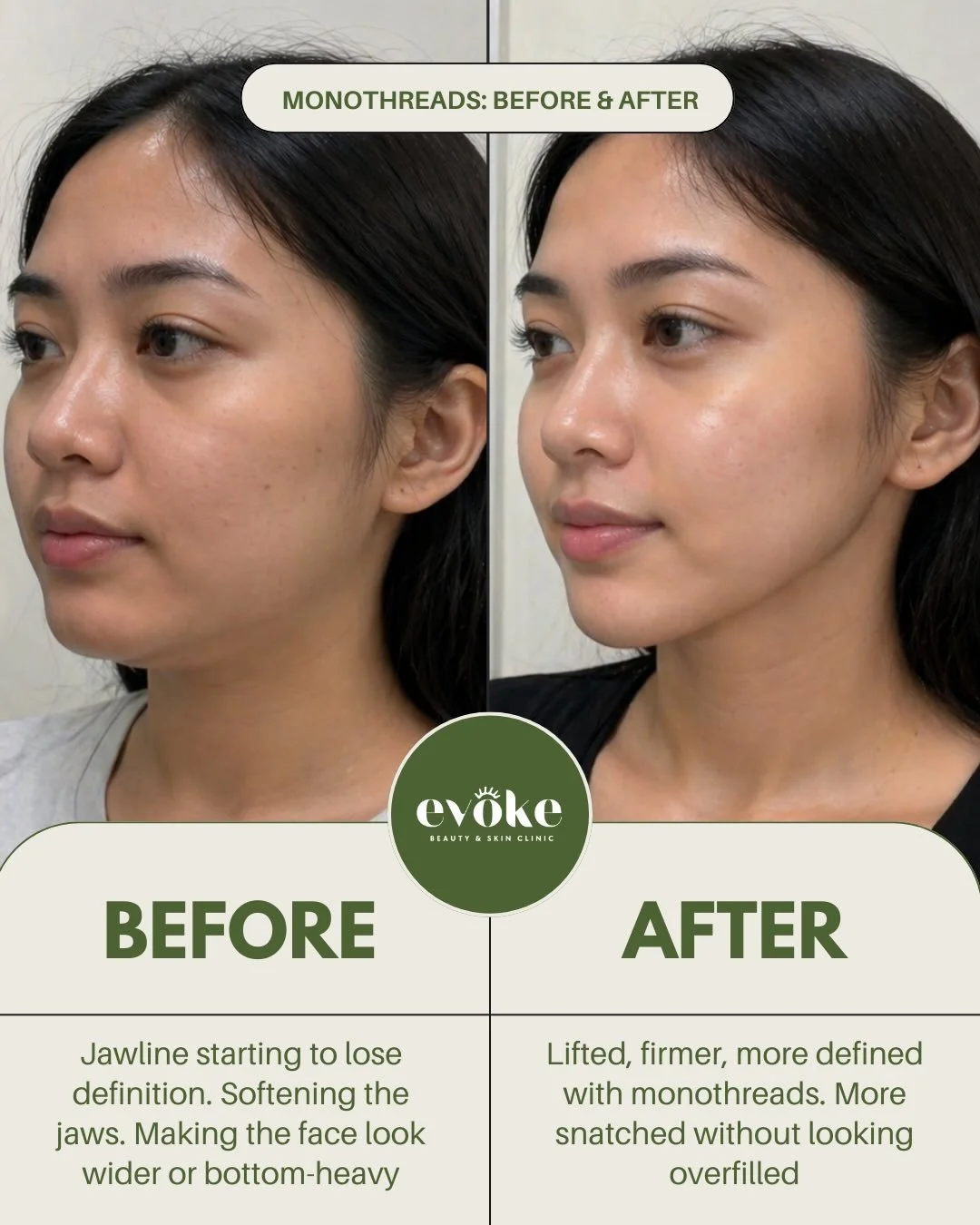 Early jowls, softer jawline, less support? Monothreads help give the lower face a firmer, more defined look. Subtle, natural-looking improvement that still looks like you.

DM us to book or ask if monothreads are right for you.