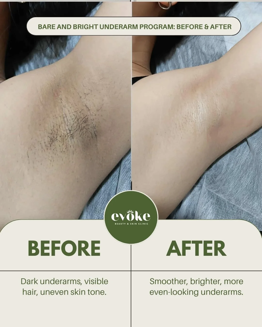 That moment you stop second-guessing your outfit because of your underarms? That&rsquo;s what we&rsquo;re working toward. 🤍 

The Bare &amp; Bright Underarm Program tackles dark underarms, unwanted hair, and uneven tone &mdash; all at once. Here&rsq