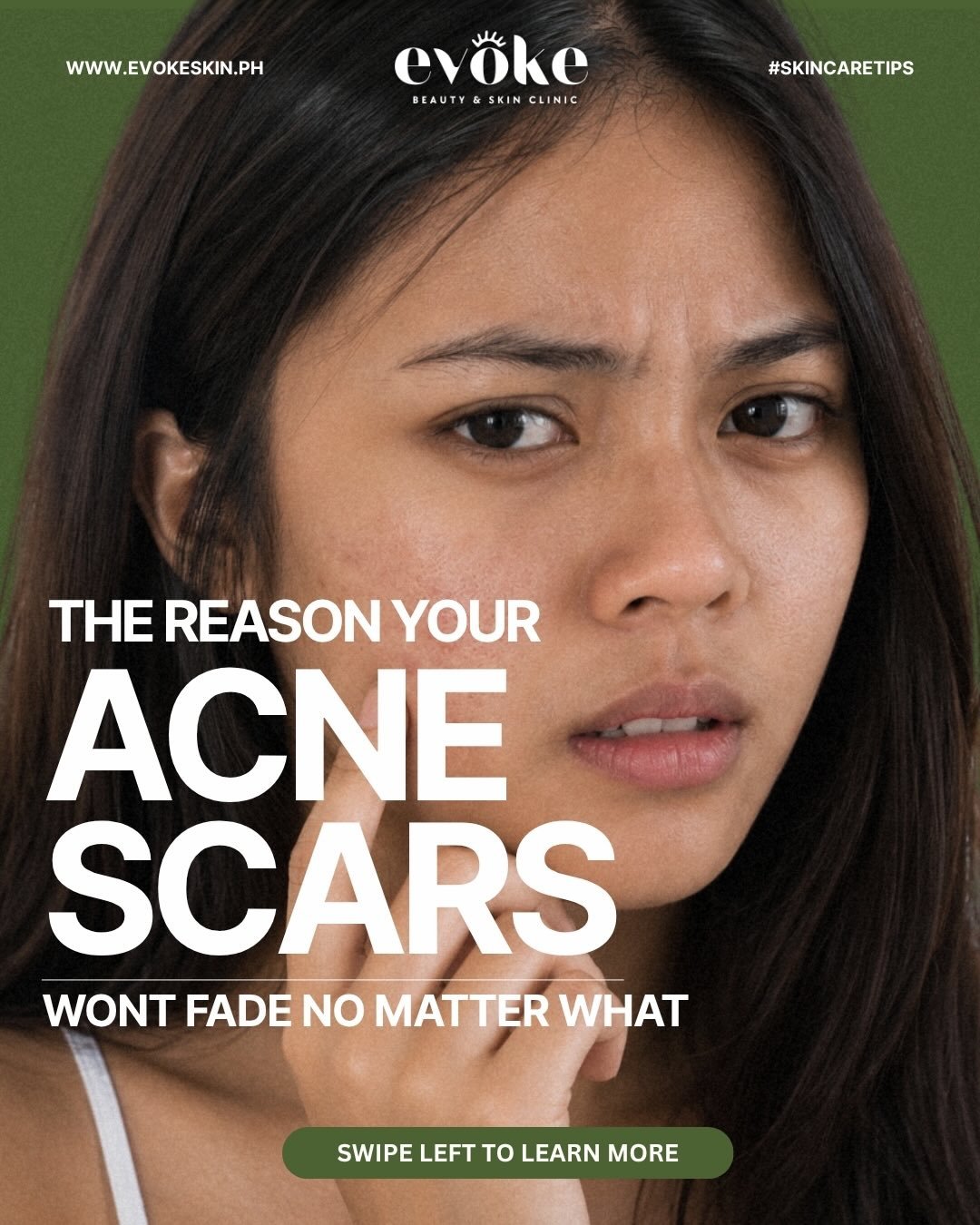 You&rsquo;ve tried everything and your acne scars still won&rsquo;t budge. 😤

Here are 6 reasons why your marks aren&rsquo;t fading (and what to do instead). Swipe through and see which one sounds like you.

The good news? Every single one of these 