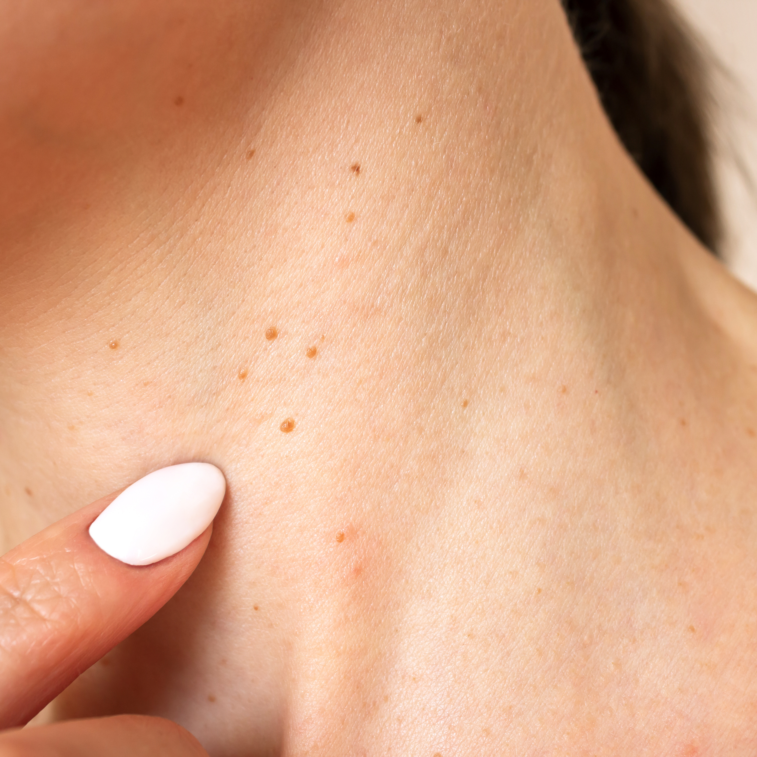 Laser Warts Removal (Unlimited)