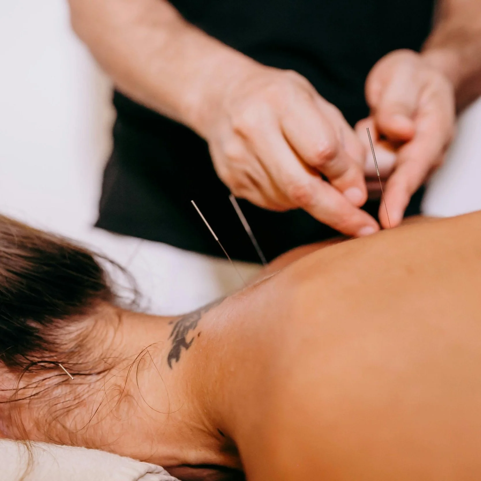 Your Path to Pain-Free: The Science Behind Our Dry Needling & Rehab Strategy