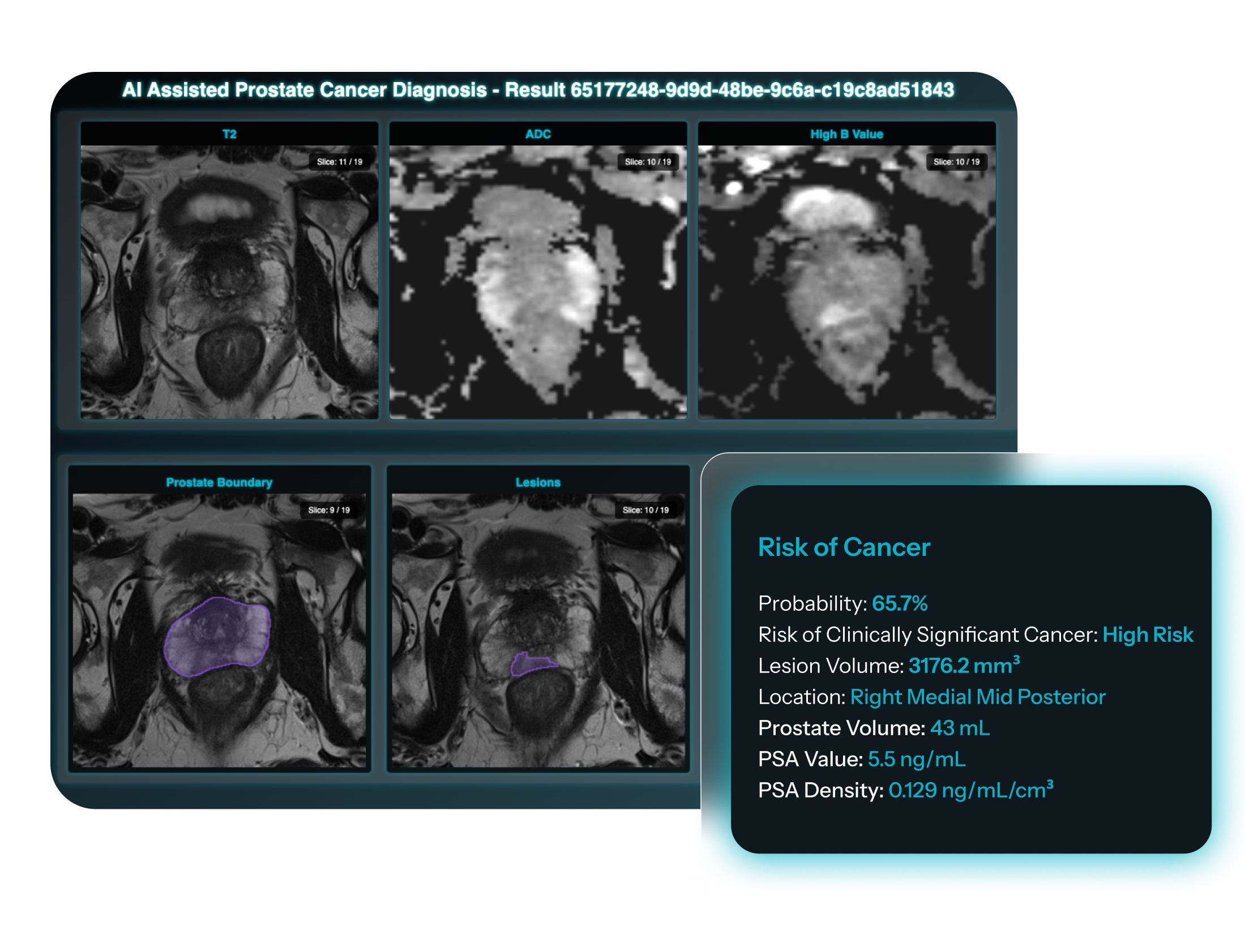 Medical scans and analysis for prostate cancer diagnosis, including MRI images, lesion mapping, and risk assessment data.