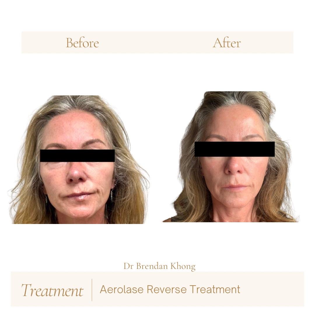 before after for reverse 02.JPG