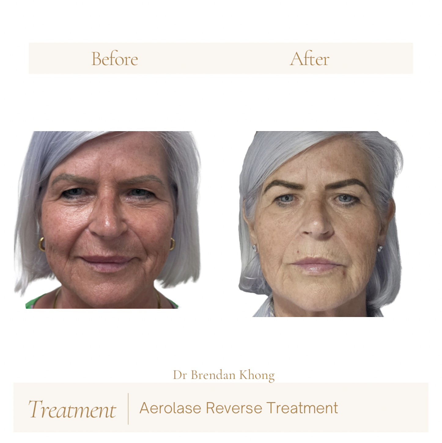 before after for reverse 04.png