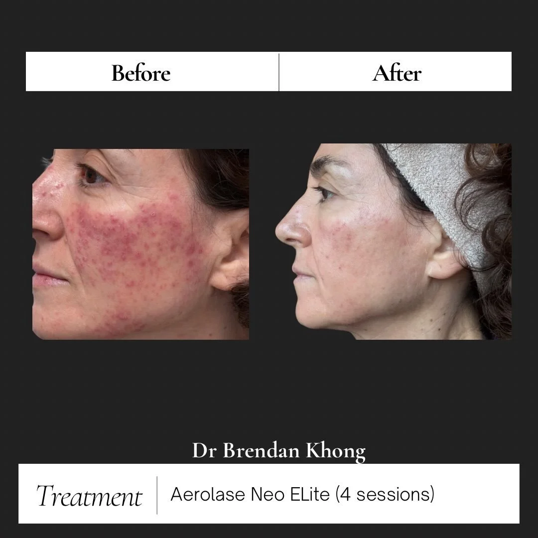 Papulopustular rosacea causes persistent redness, flushing, and acne-like breakouts (without blackheads or whiteheads).

These results are after 4 sessions with the Aerolase Neo Elite! One of my absolute faves for calming redness and inflammation ✨

