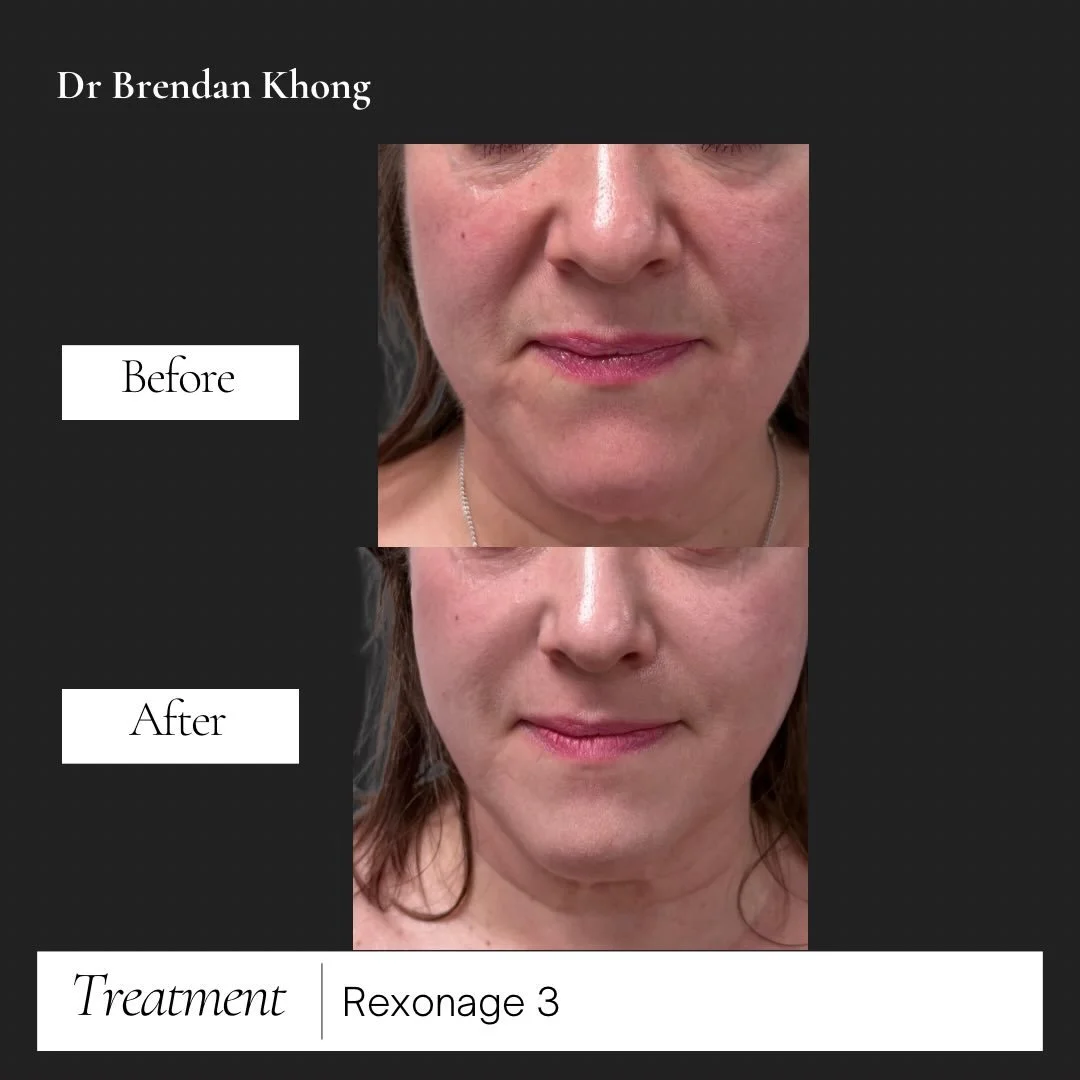 See the difference Rexonage 3 can make! 

Nasolabial lines are visibly softened and the skin looks smoother and more refreshed. Rexonage 3 isn&rsquo;t just about reducing fine lines it supports overall skin health and encourages natural collagen rege