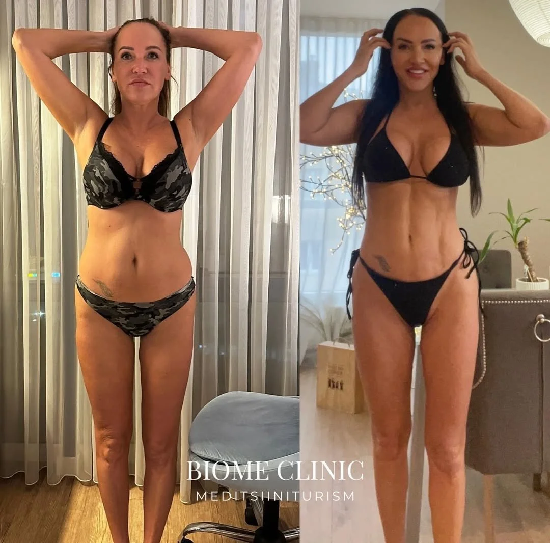 Ly imekaunis figuur on saavutatud tänu kehakontuurimisele. ✨Protseduurist on möödas kaks aastat,.jpg