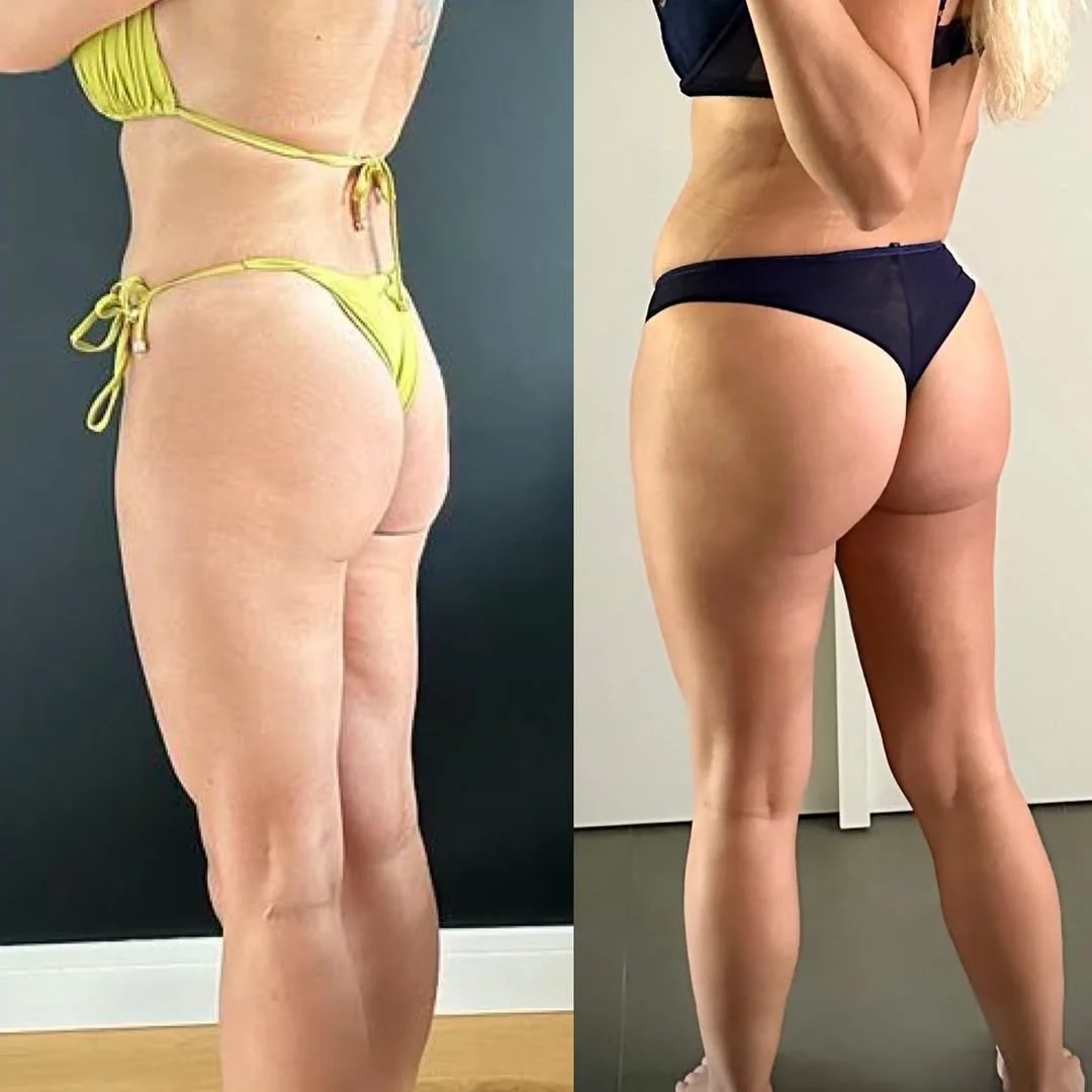 Vaser rasvaimu ja BBL 🍑✨Meie poole pöördus Eesti meedik, kes oli üle elanud kaks ebaõnnestunud .jpg