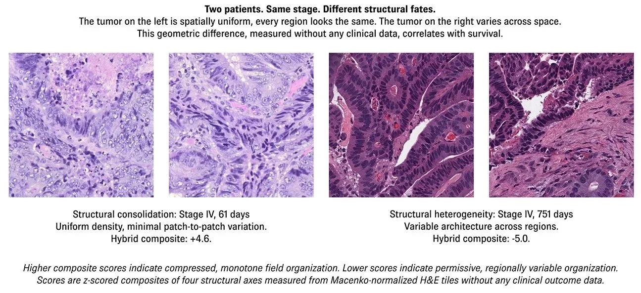 Comparison of two histology slides of tumor tissue from two patients at different stages and with different structural traits. The left shows uniform, densely packed tissue with minimal variation, while the right displays variable architecture with heterogeneity across regions.