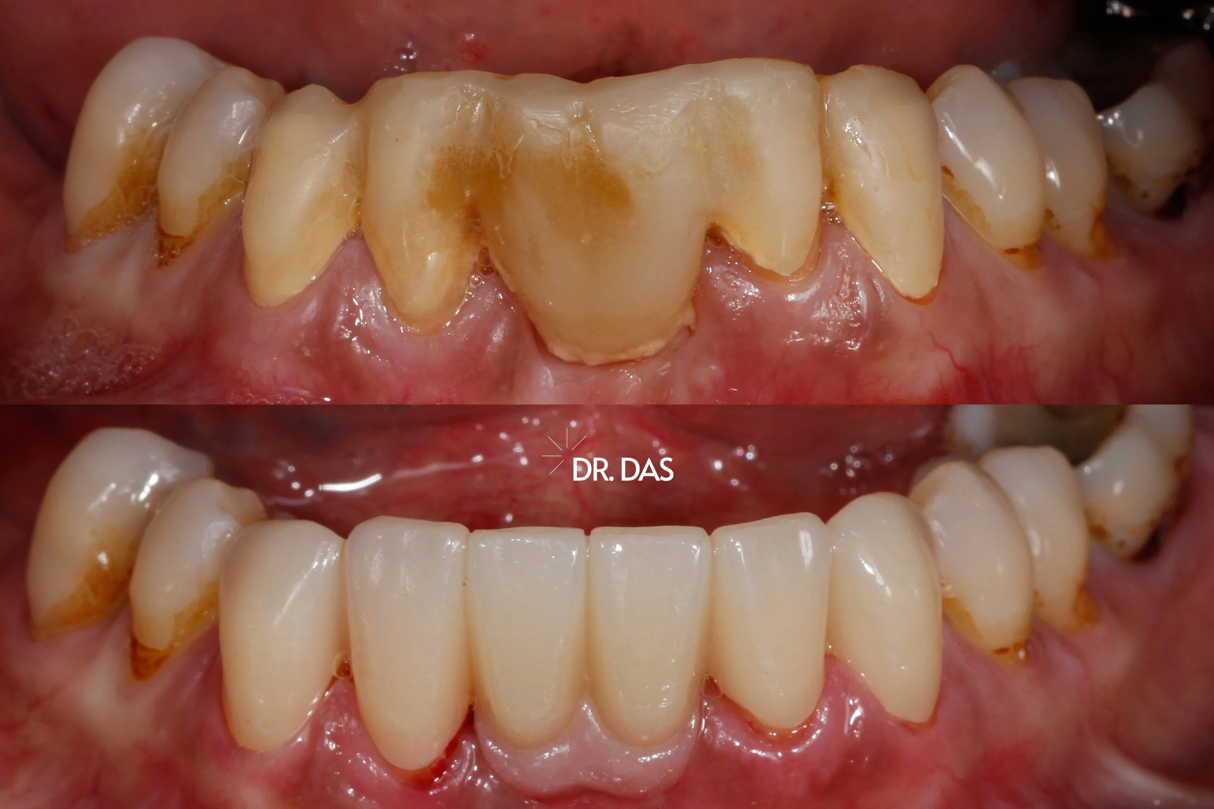 Vorher-Nachher-Bilder von einem Zahnarzt, der eine Zahnreinigung oder ästhetische Zahnkorrektur an den unteren Schneidezähnen durchgeführt hat.