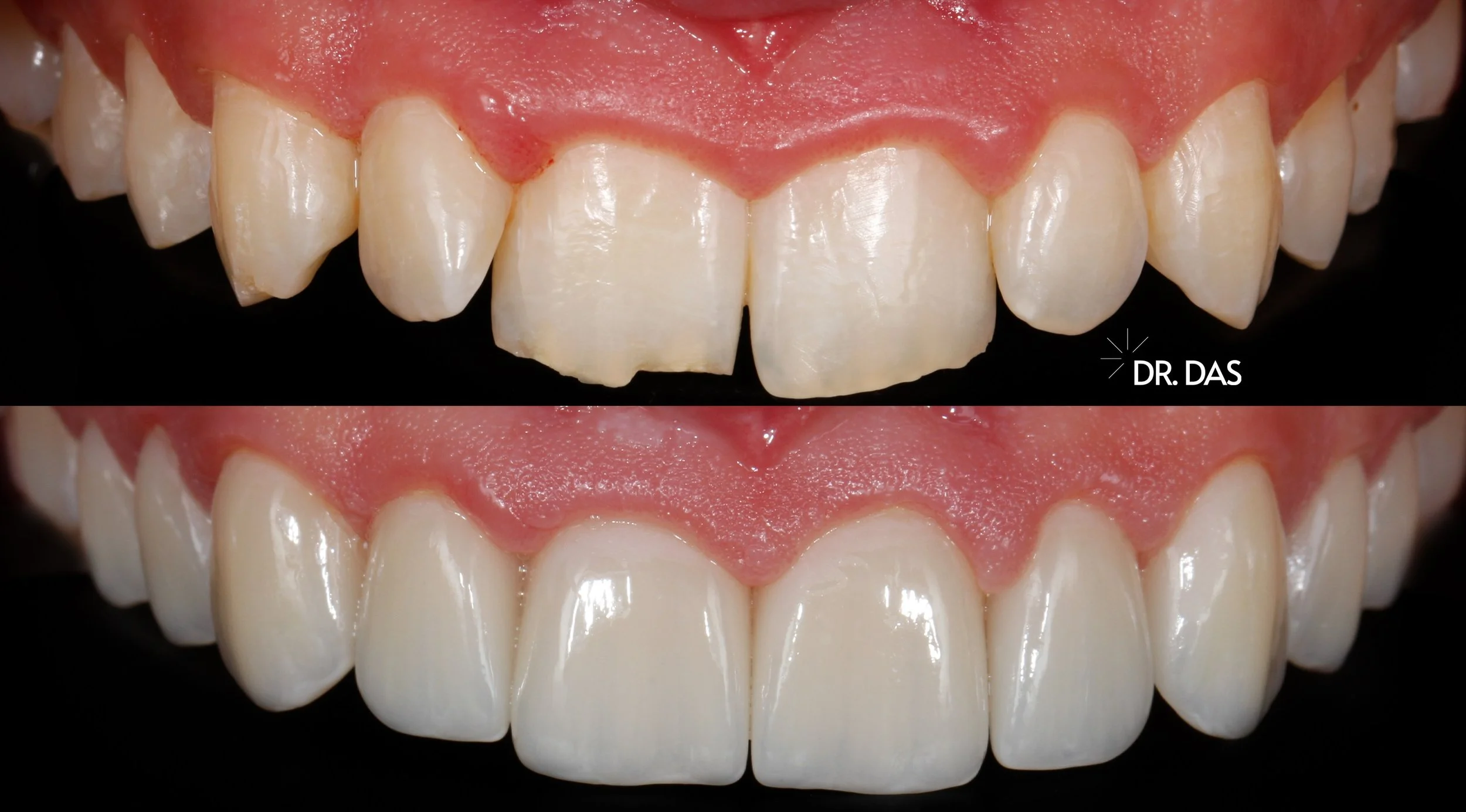 Vorher-Nachher-Bild eines Frontzahnarzts, der eine kieferchirurgische Behandlung präsentiert, wobei die oberen Zähne im unteren Bild deutlich weißer und gerade sind.