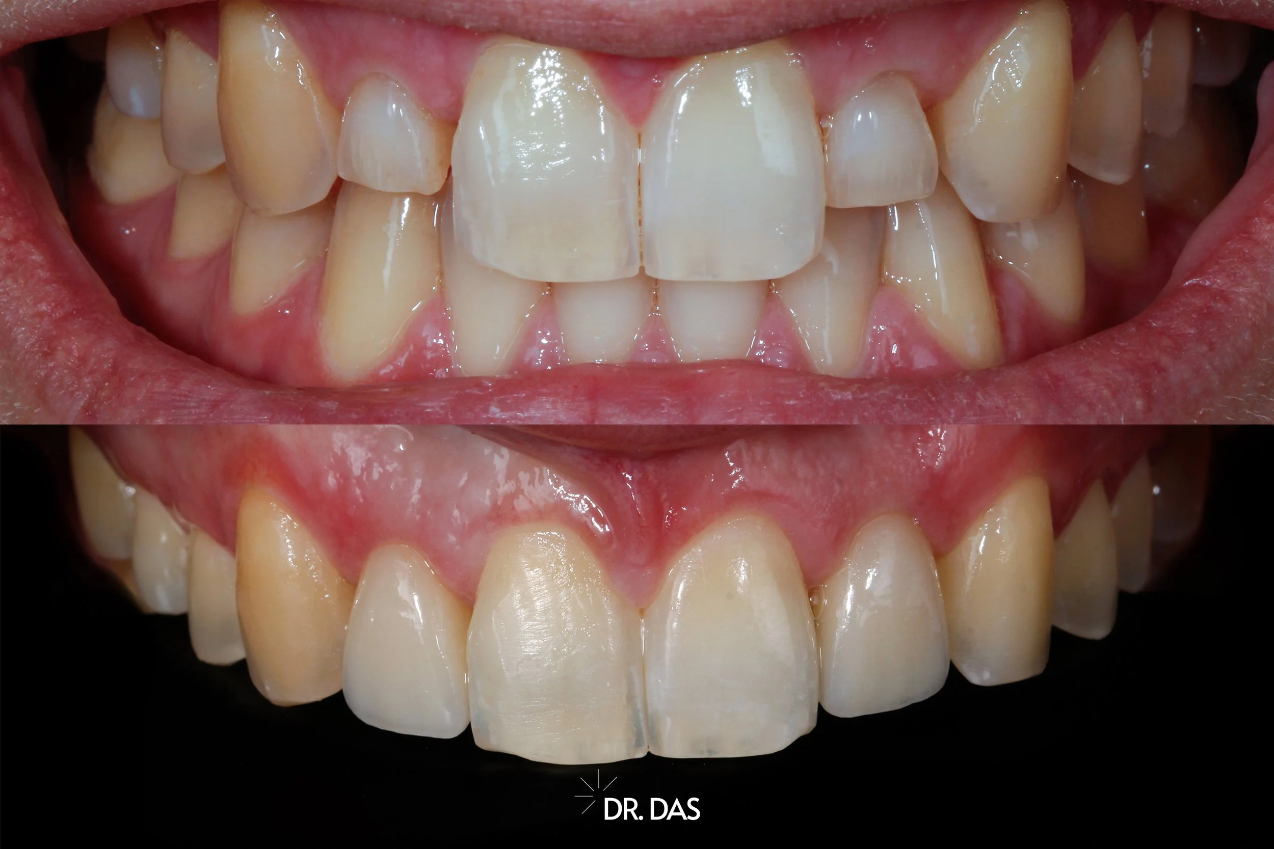 Vorher-Nachher-Bild von Zähnen, obere und untere Zähne, mit sichtbaren Zahnfehlstellungen im oberen Bild und geraden, reparierten Zähnen im unteren Bild. Dr. Das.