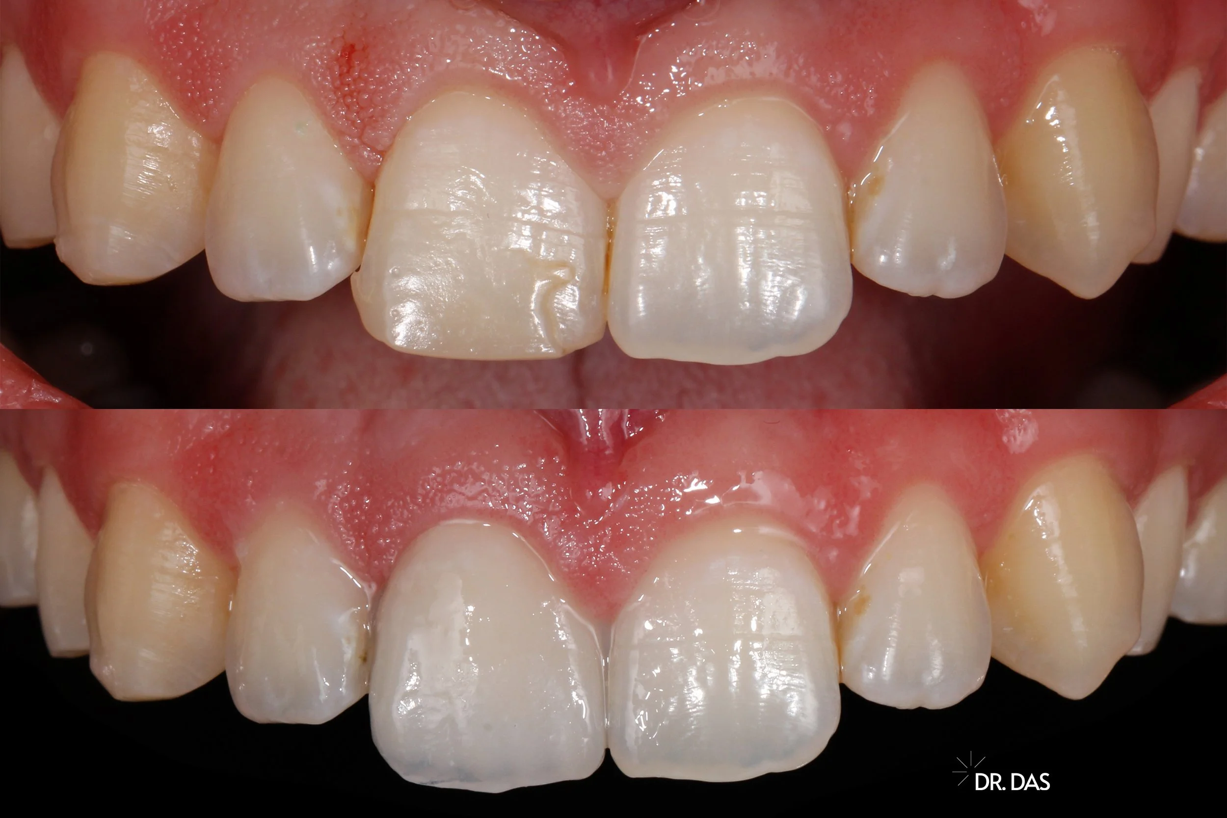 Vergleich eines unbeschadeten und restaurierten Zahnes im oberen Schneidezahnbereich, sichtbarer Unterschied durch Zahnsanierung.