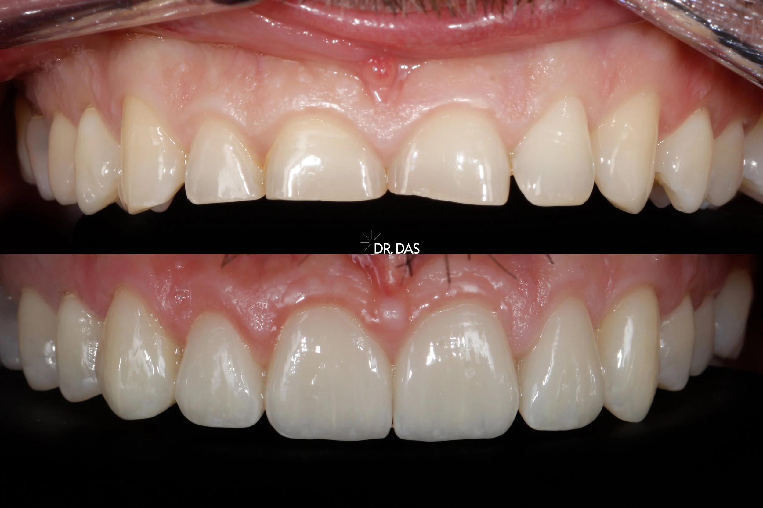 Vergleich von Zähnen vor und nach einer kosmetischen Behandlung, obere und untere Zahnreihen fokussiert
