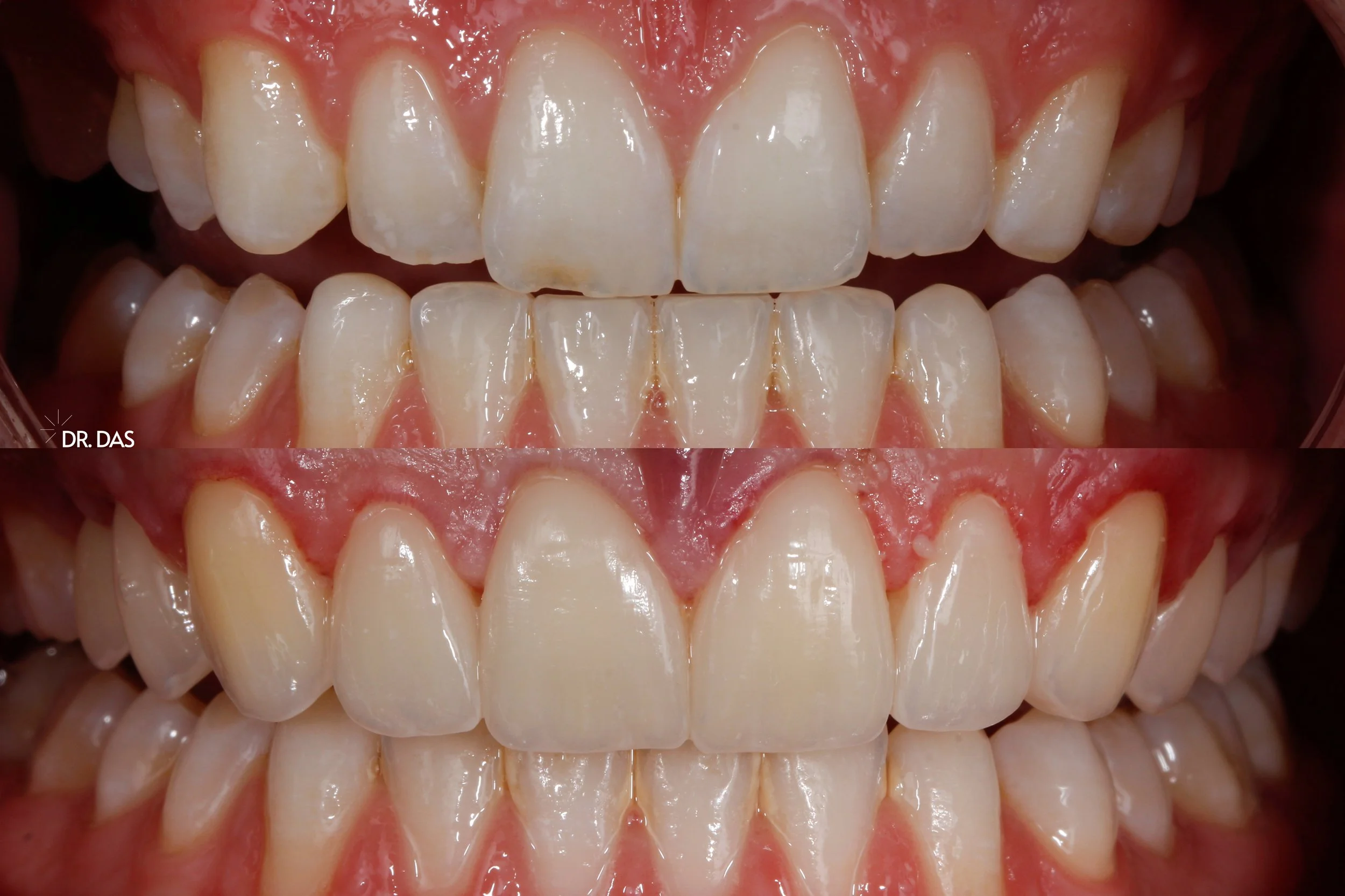 Vorher-Nachher-Bild von Zahnaufhellung. Oben ungebleichte, verfärbte Zähne, unten aufgehellte, weißere Zähne.