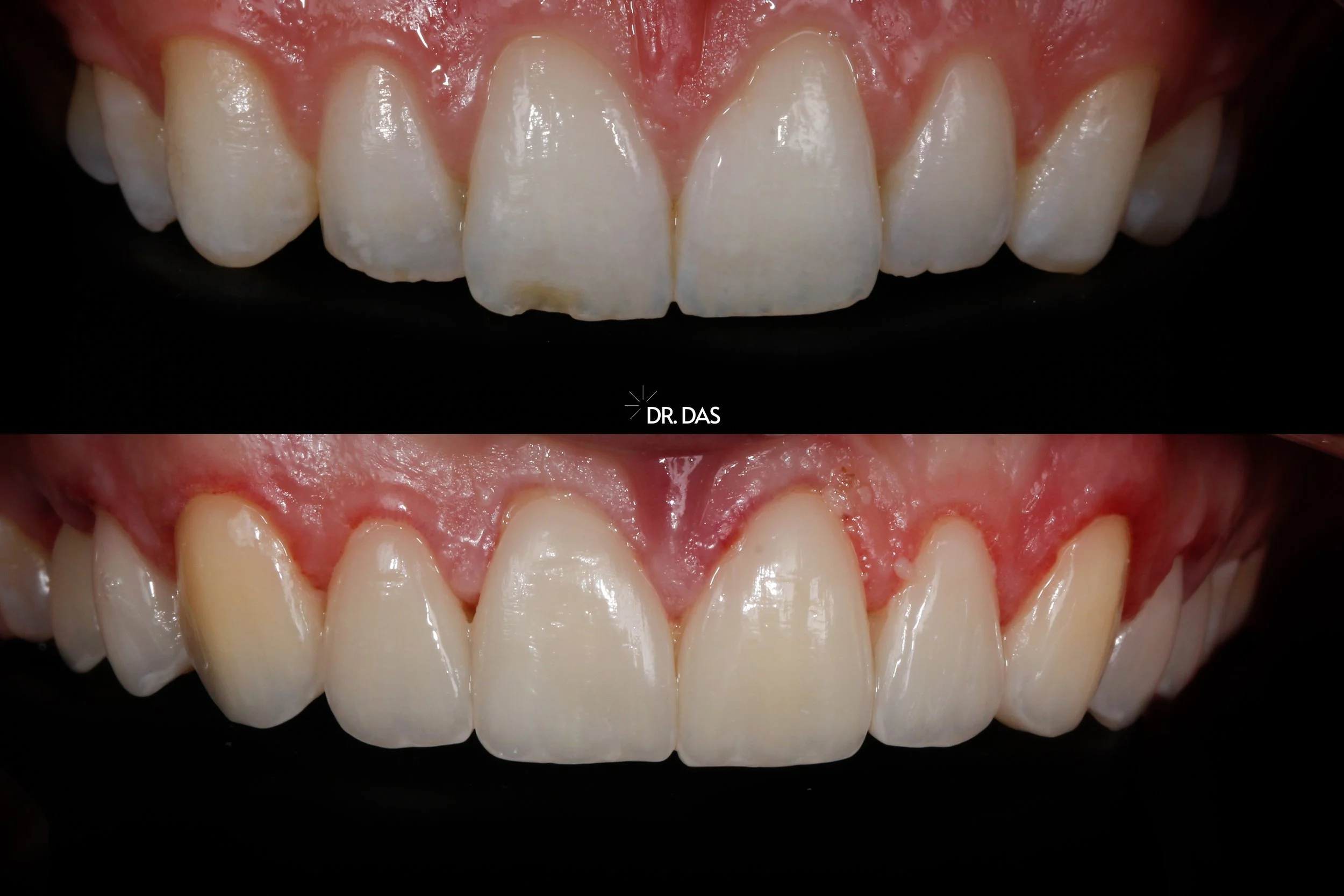 Vorher- und Nachher-Bild von Zahnreparaturen, bei denen beschädigte Vorderzähne restauriert wurden, um ihre Ästhetik zu verbessern.