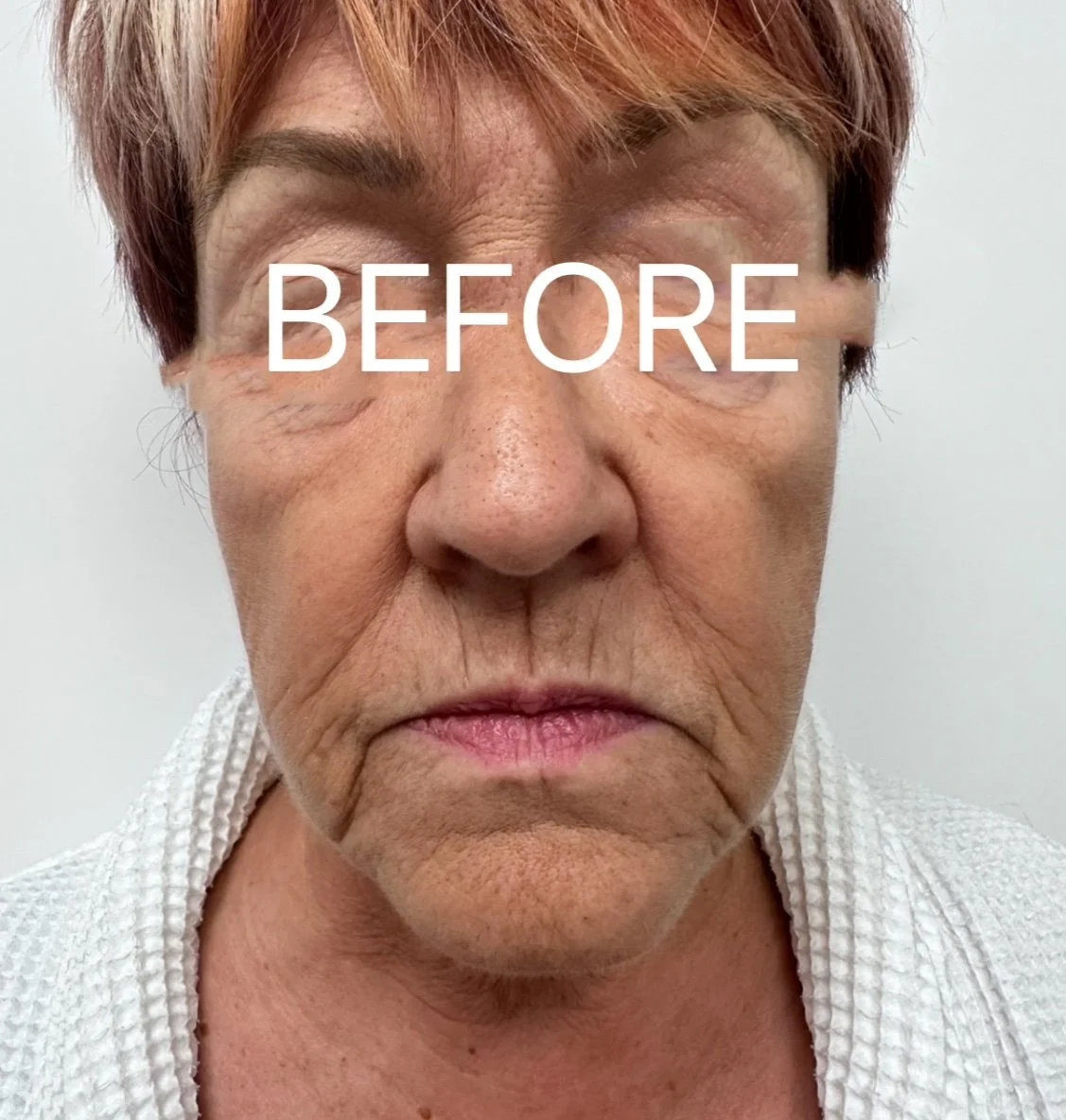 Plexr Plasma/Medical Grade Peels
(Fine Lines, Wrinkles, Skin Tightening, Contouring.)