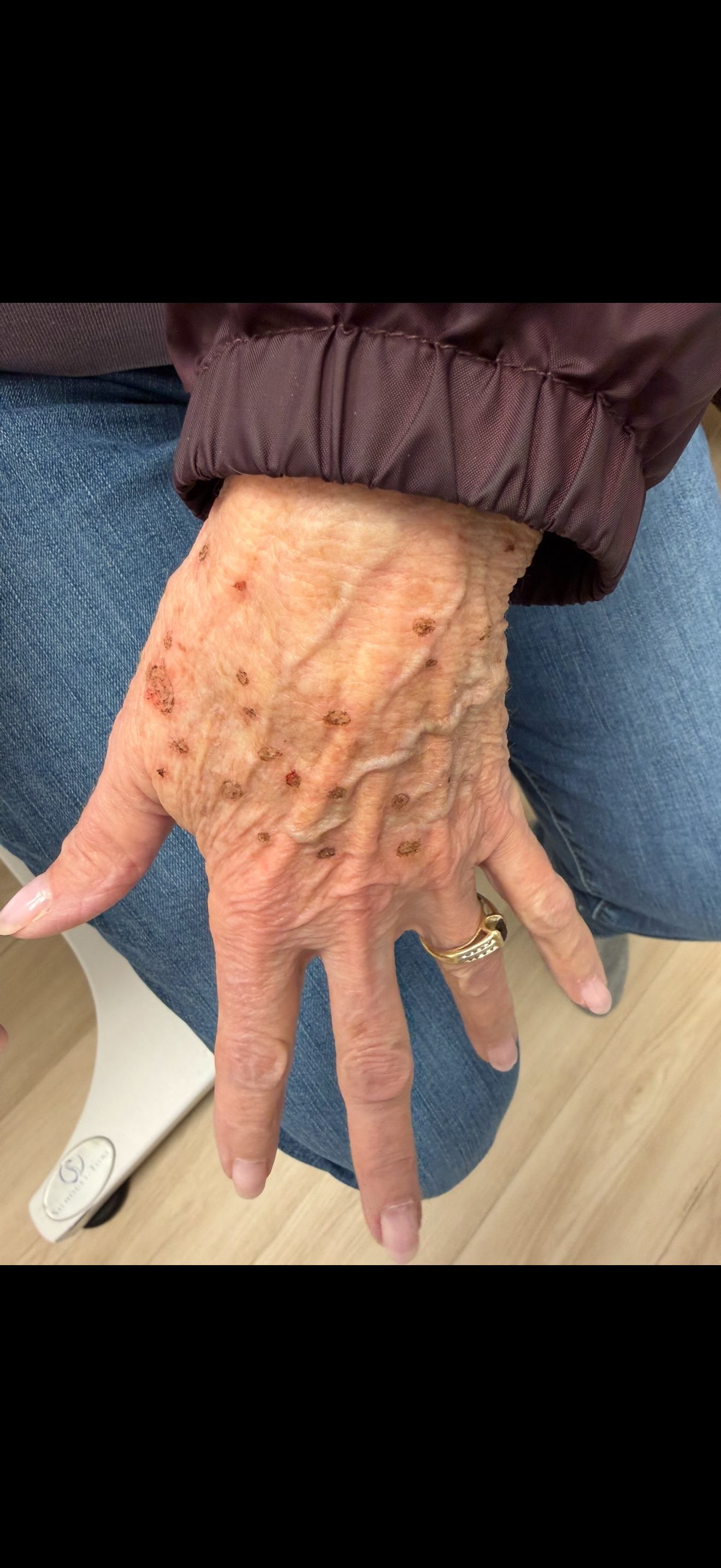 Plexr Plasma (Left Hand Age Spots) Before