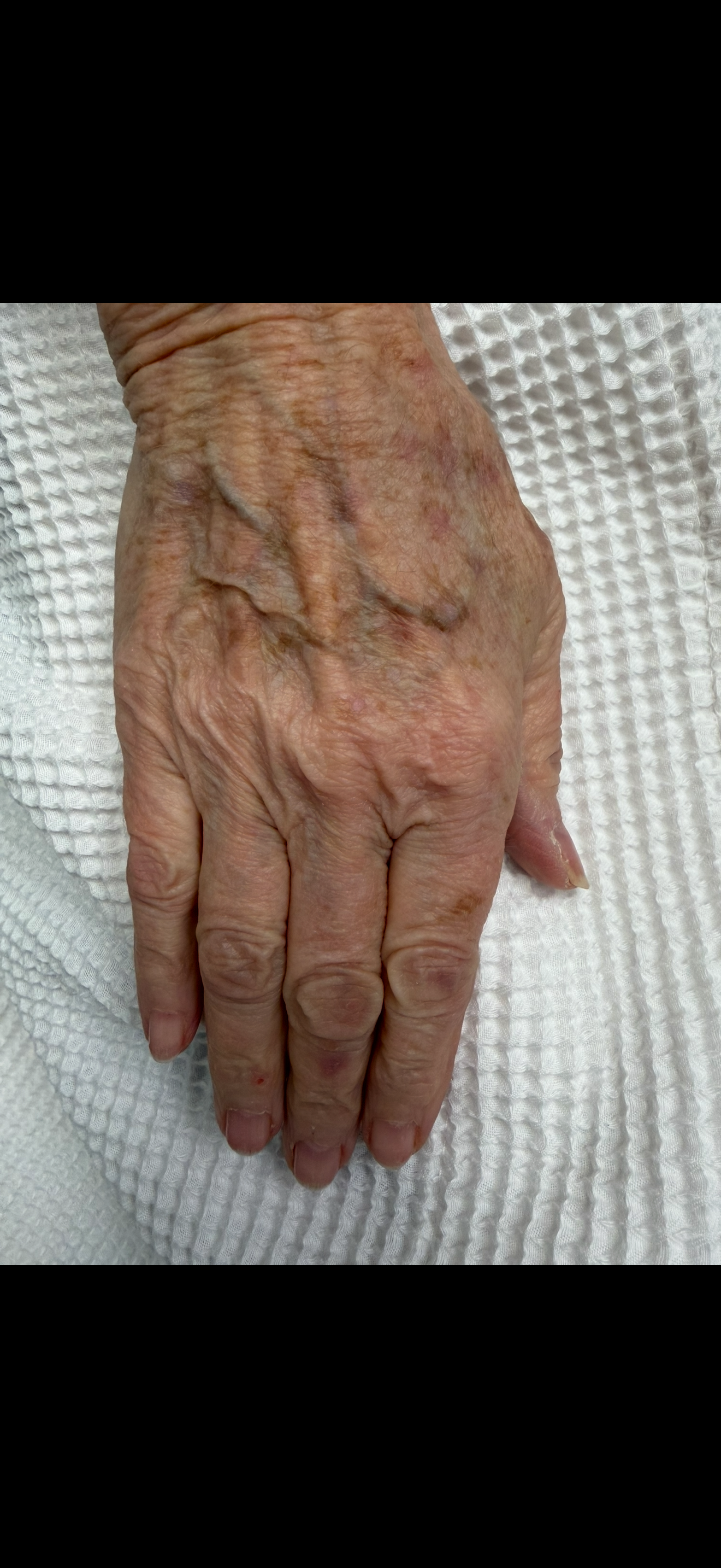 Plexr Plasma (Right Hand Age Spots) After