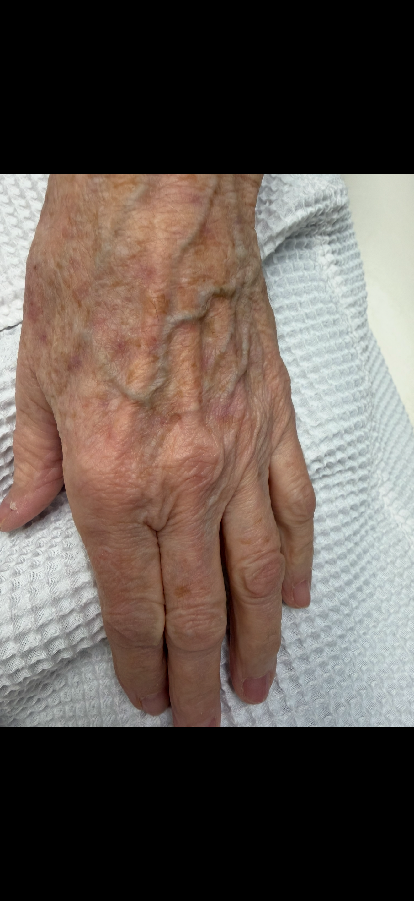Plexr Plasma (Left Hand Age Spots) After