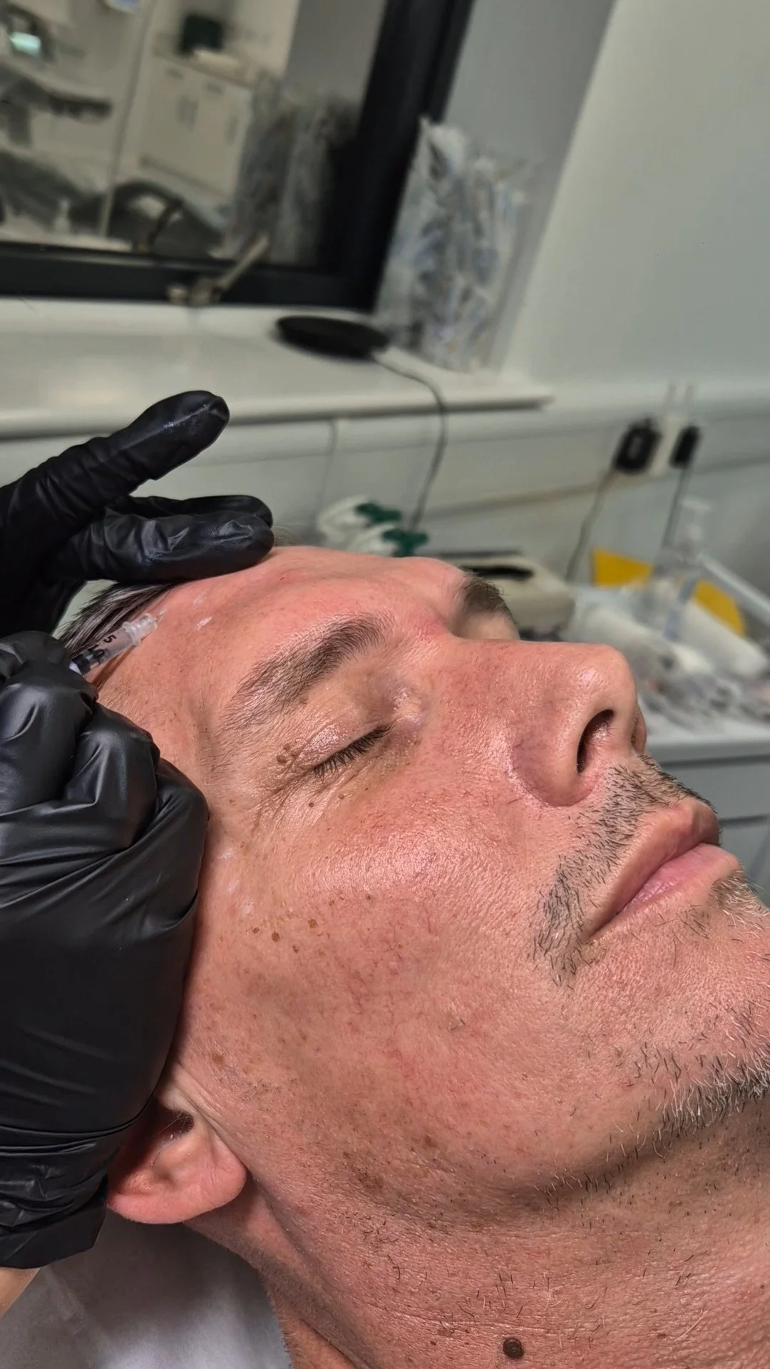 Wrinkle reduction / Tox Treatments