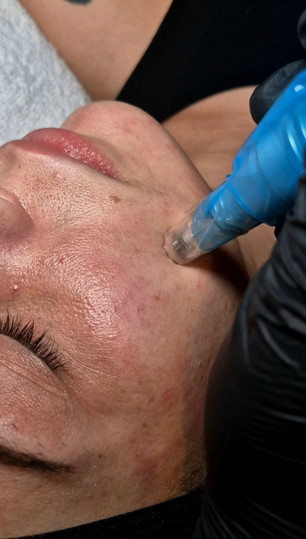 Microneedling