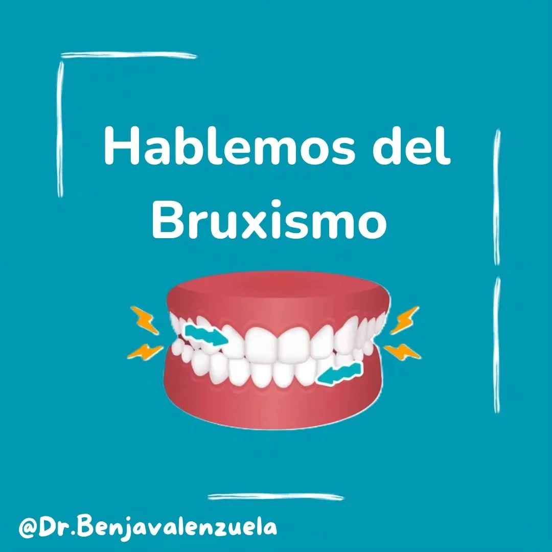 &iexcl;Hola a todos! Ya estamos de vuelta de las vacaciones y comenzando un nuevo a&ntilde;o con todo 💪

A pedido de algun@s, hoy hablaremos sobre una condici&oacute;n muy com&uacute;n: El Bruxismo😨

En el siguiente post encontrar&aacute;s informac