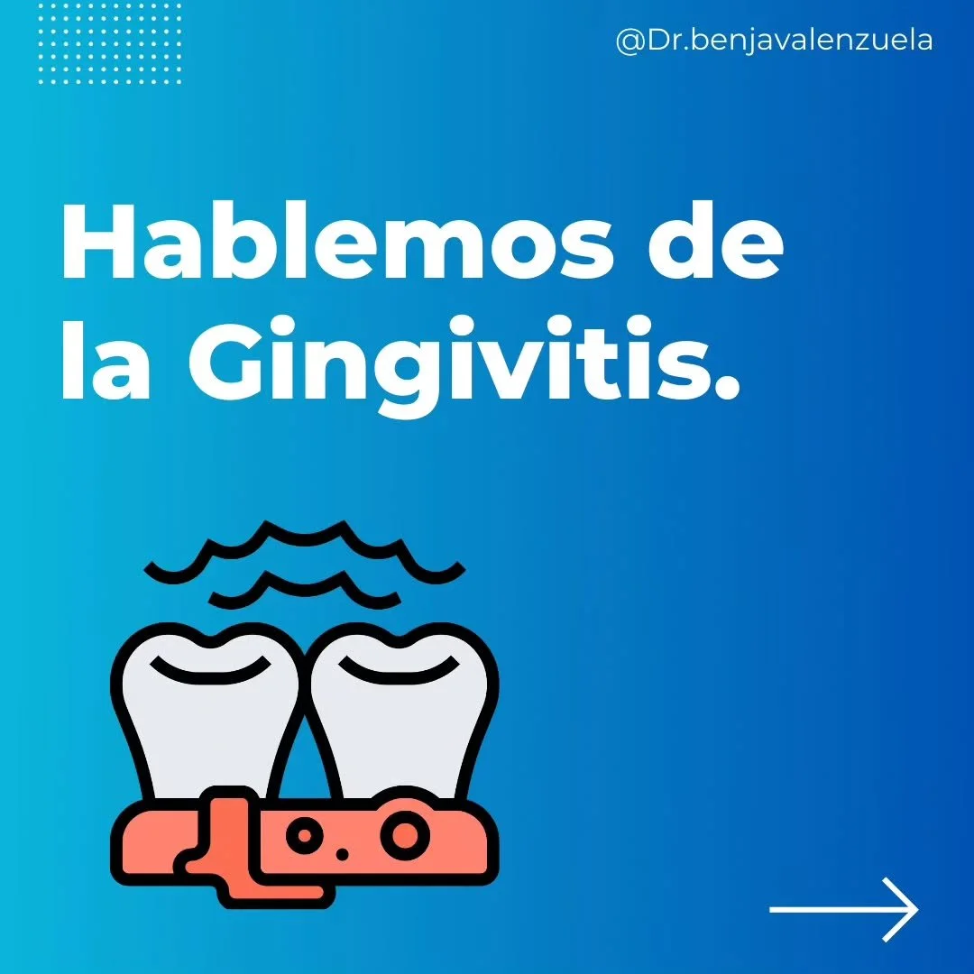 Hoy hablaremos sobre una de las enfermedades orales m&aacute;s prevalentes en nuestro pa&iacute;s: La Gingivitis‼️🦷

En el siguiente post te contamos c&oacute;mo identificarla y cu&aacute;les son sus tratamientos m&aacute;s comunes🪥👆🏼

&iexcl;Nos