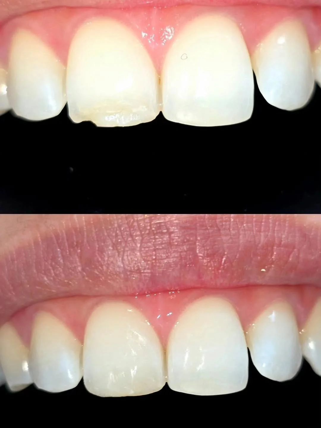 Porque peque&ntilde;os detalles generan grandes cambios 💪🏻

Les comparto un caso de esta semana que me gust&oacute; mucho. Este trabajo con resina compuesta incisal es un gran ejemplo de la mentalidad odontol&oacute;gica minimamente invasiva. 

Y a