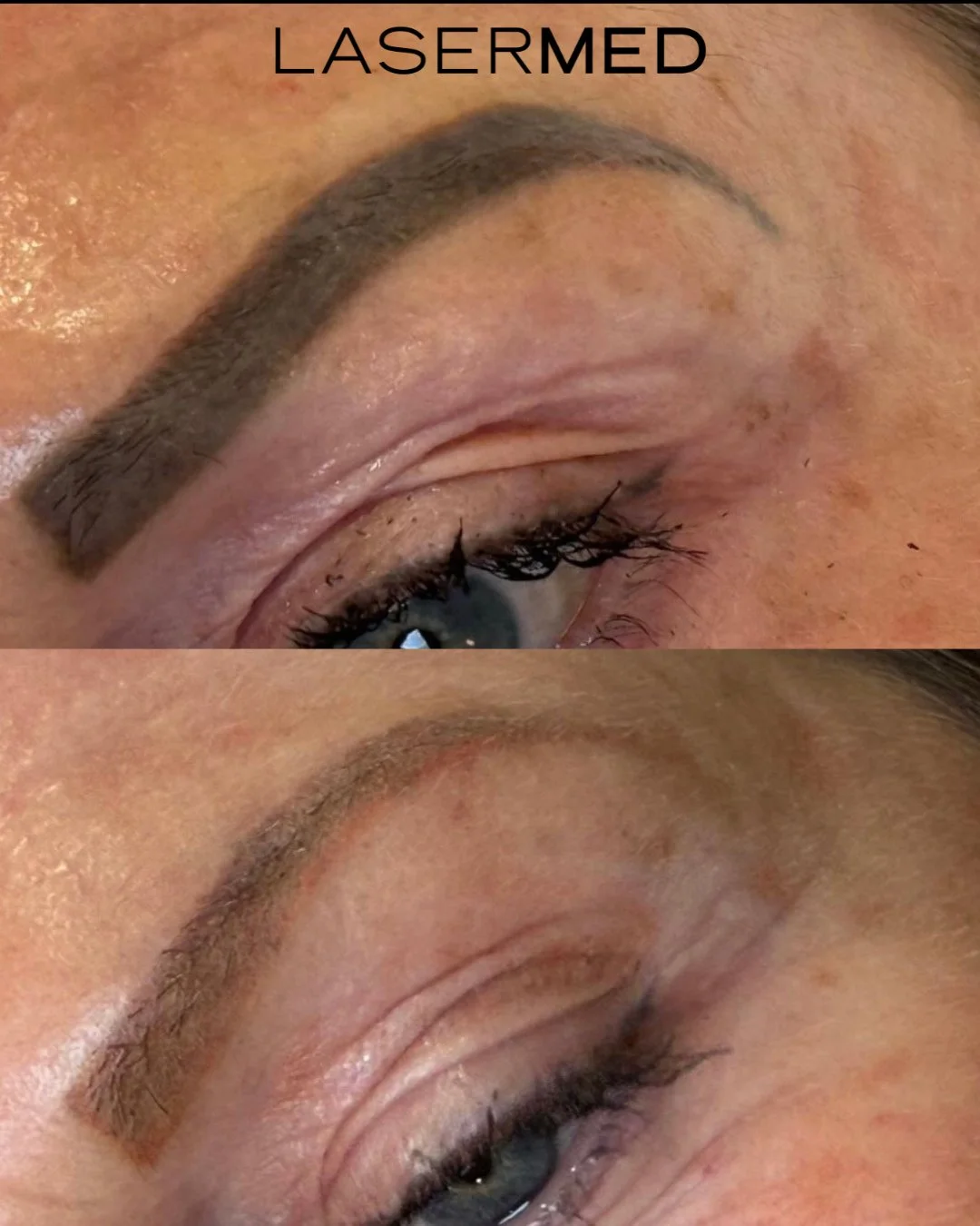 ✨ One Session Transformation ✨
Can you believe this is after just ONE permanent makeup removal session?! 💖
From dark, heavy brows ➡️ to soft &amp; natural looking again.

Tattoo removal doesn&rsquo;t have to be scary &ndash; sometimes one session is
