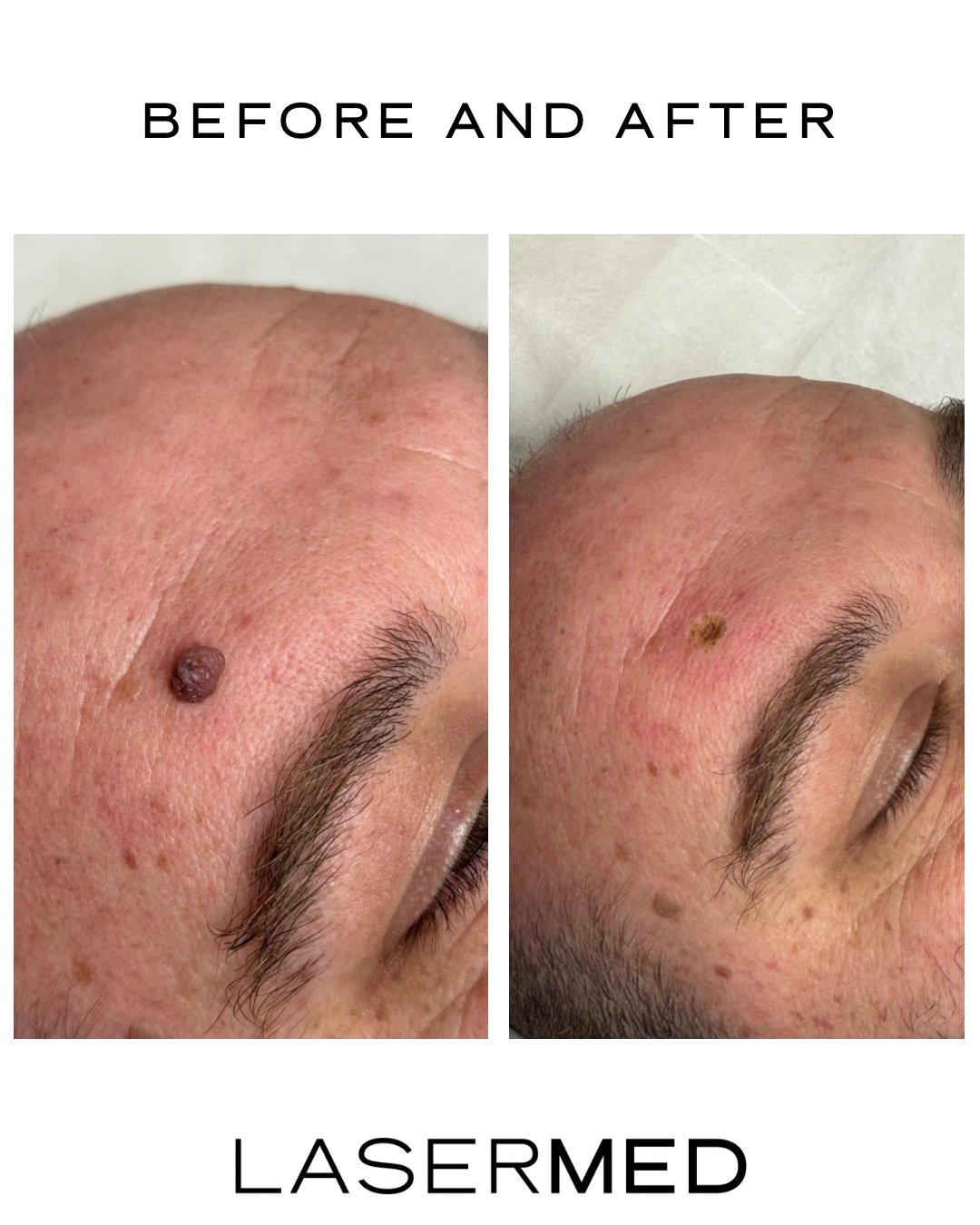 Lesion Removal &ndash; Before &amp; After

At LaserMed, we safely remove benign skin lesions with precision and minimal downtime.
This client&rsquo;s raised lesion was treated in a single session, leaving behind a small, dry scab that will naturally 