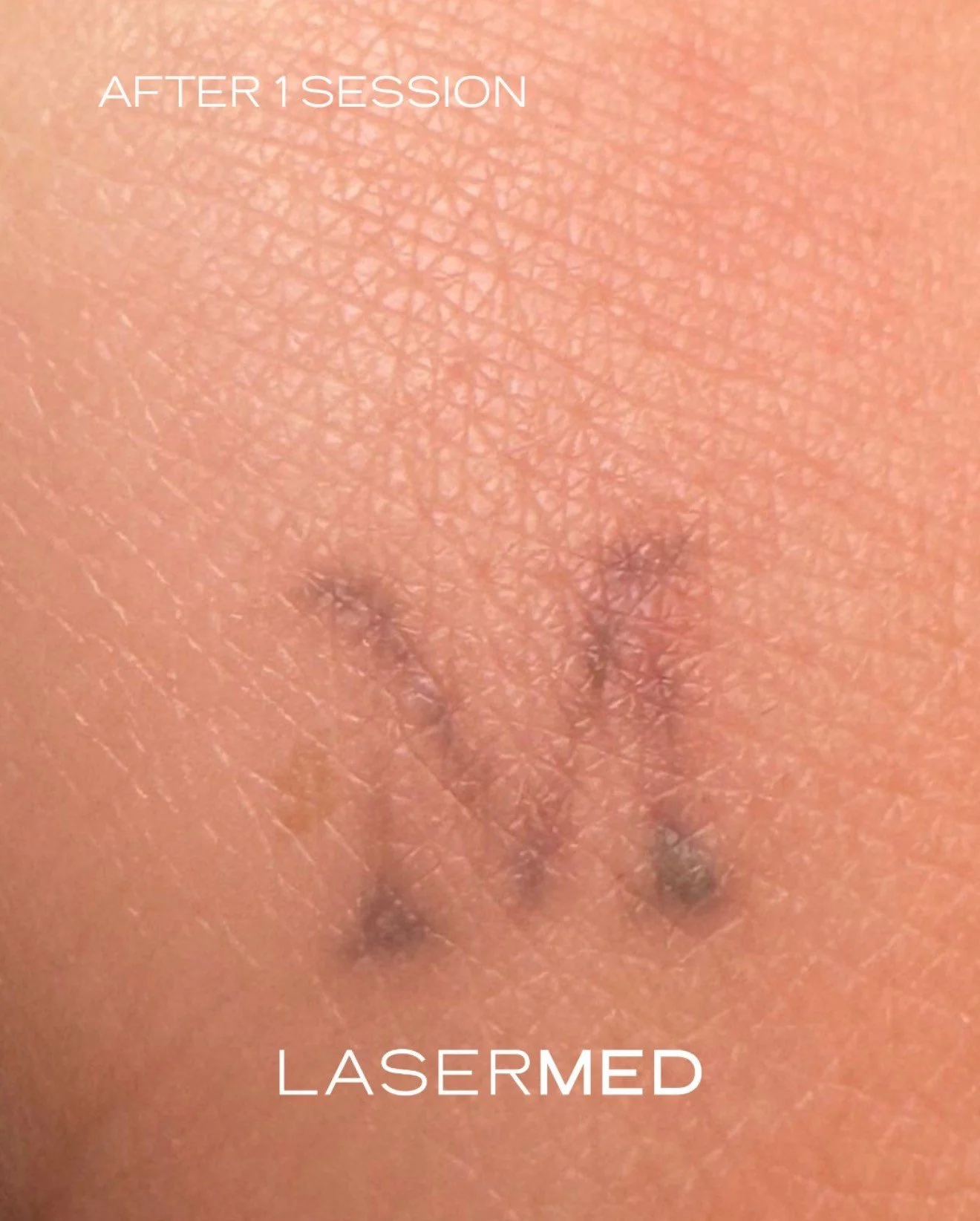 Laser Tattoo Removal - just 1 session in!
The incredible difference after just ONE session of laser tattoo removal at LaserMed *
Using advanced AW3&reg; laser technology, we're able to safely break down unwanted ink with minimal discomfort and no dam