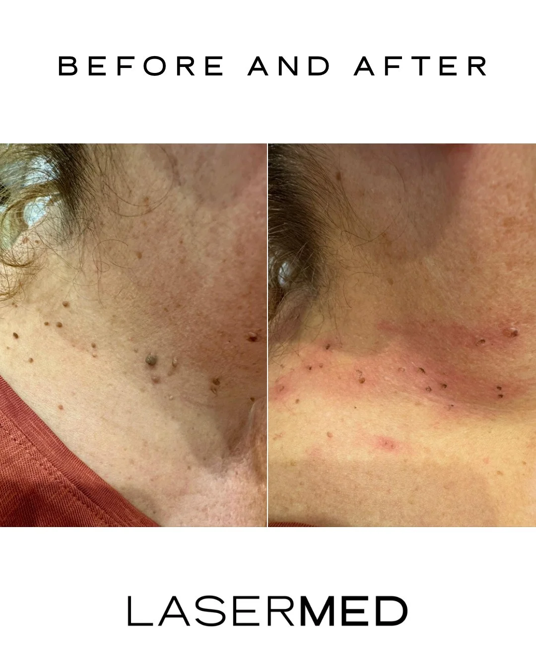 ✨ Goodbye blemishes, hello confidence ✨
Another glow-up complete at LaserMed 🤍
Results you can see. Confidence you can feel.

Ready to tackle your unwanted skin concerns? Book your consultation today via the link in bio!