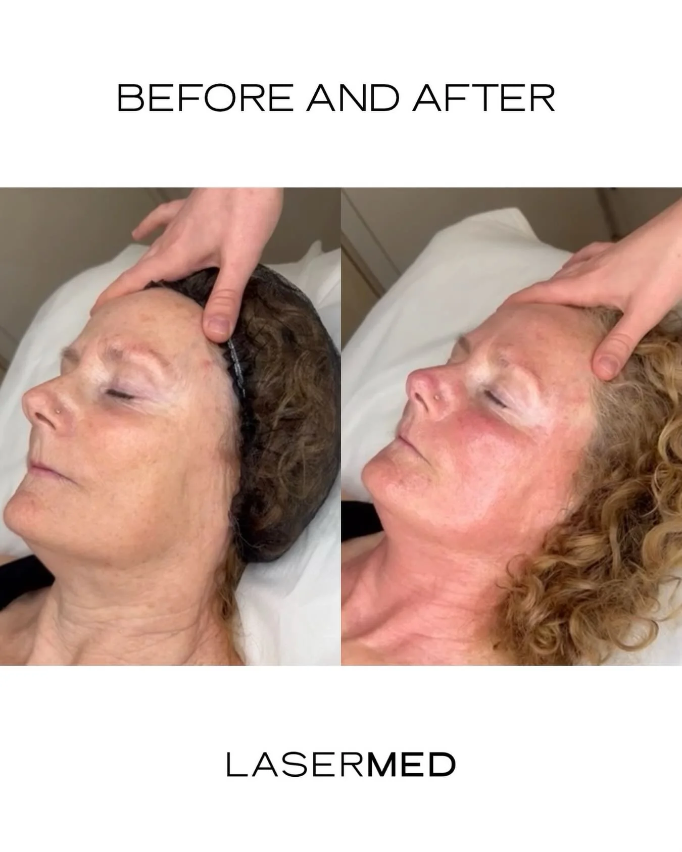 Let&rsquo;s talk about what&rsquo;s actually happening here 👇

Radio Frequency Microneedling combines two powerful technologies:
&bull; Microneedling to trigger your skin&rsquo;s natural healing response
&bull; Radio frequency energy to heat the dee