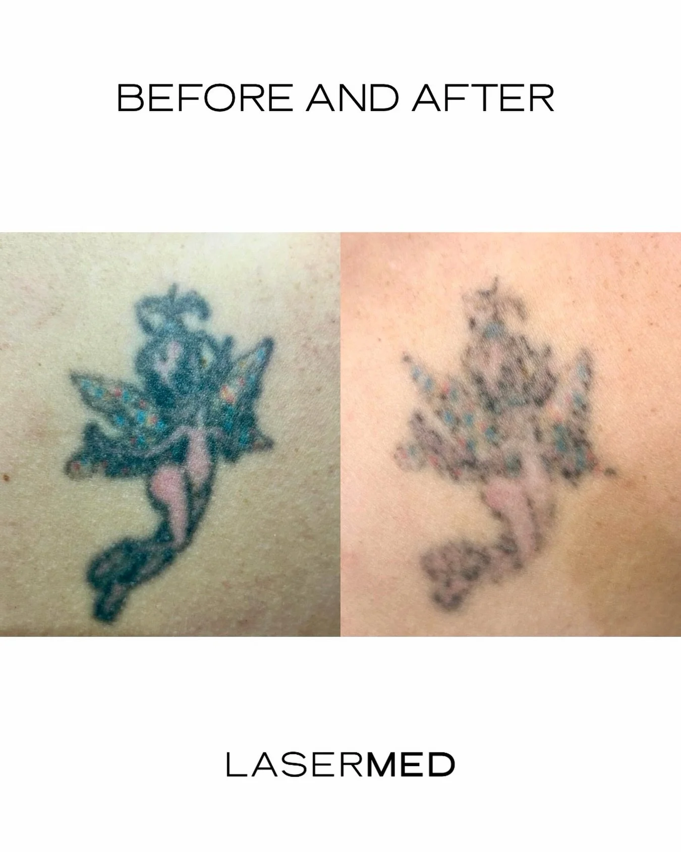 Amazing early results&mdash;looking forward to guiding this client through the full removal journey 🤩

Laser works by breaking the ink into tiny particles, which your body gradually clears. It&rsquo;s a process, not a quick fix.

&bull; Visible fadi