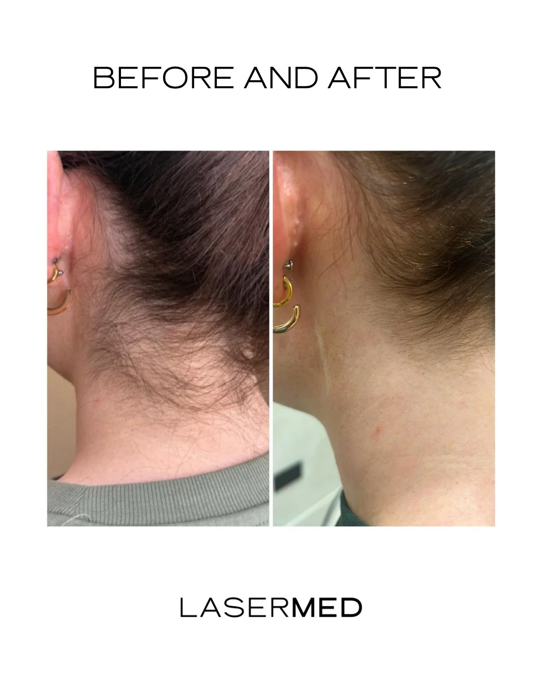 Small detail, big impact. ⁠
⁠
Laser hair removal helps reduce unwanted hair growth at the root, creating a smoother, more refined finish that's easier to maintain long-term. ⁠
⁠
If your considering laser hair removal, we're here to guide you. ⁠

Send