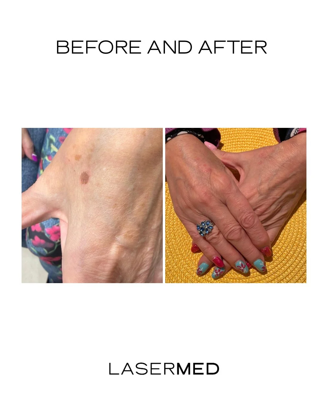 In experienced hands, your skin is always the priority. ⁠
⁠
With a paramedic practioner behind every treatment, age spots on the hands can be treated with care and precision for a more even, refreshed appearance. ⁠
⁠
If you're looking to improve skin