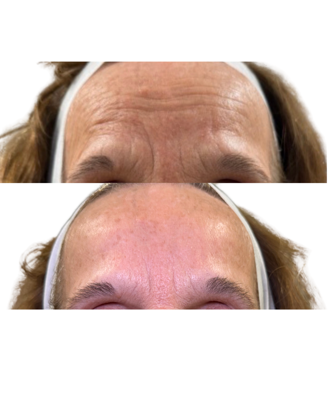 Before and After Exion Radio frequency Microneedling