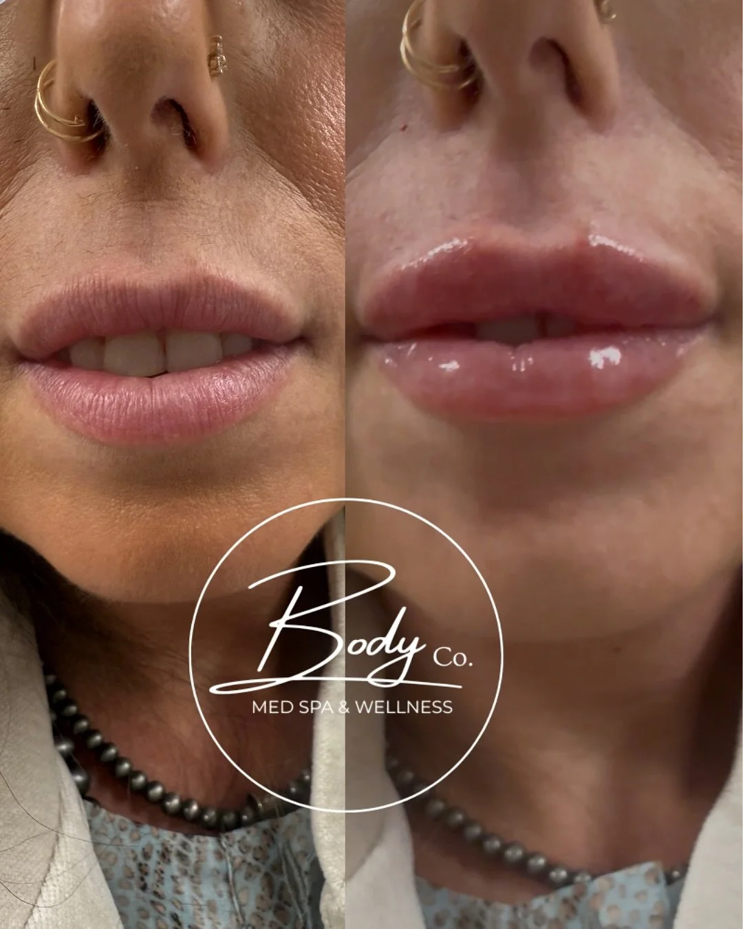🪄👄 Refreshed, refined, and rehydrated. 

Treatment: 
Painless Lip Filler Service with Dental Block
- Expect swelling/possible lumps for 2-4 weeks
- Possible Bruising 
- Fully healed by week 4
- Individual results may vary

By @robynkc_np 👩&zwj;⚕️ 